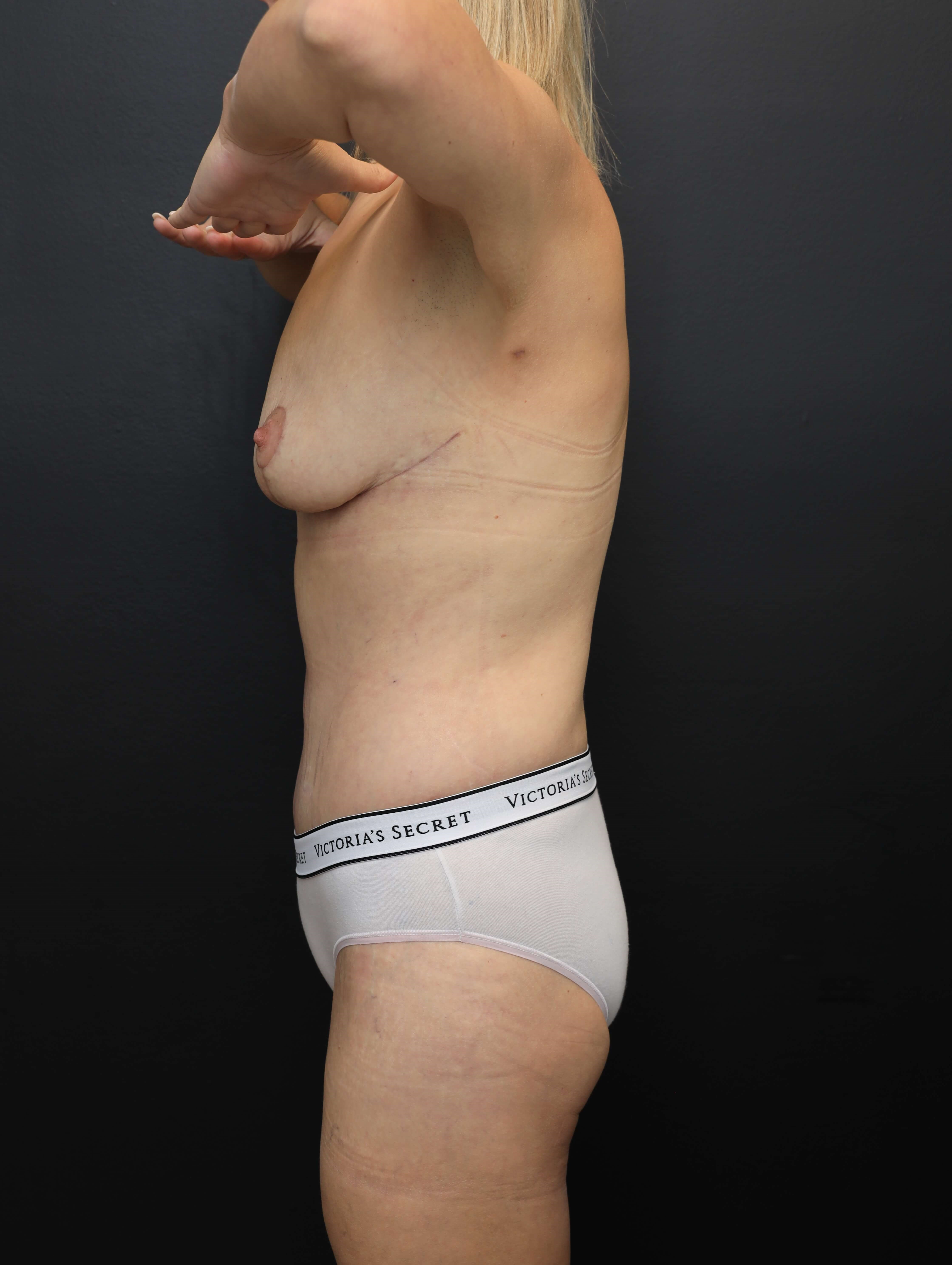 Left Lateral - Arms Up After