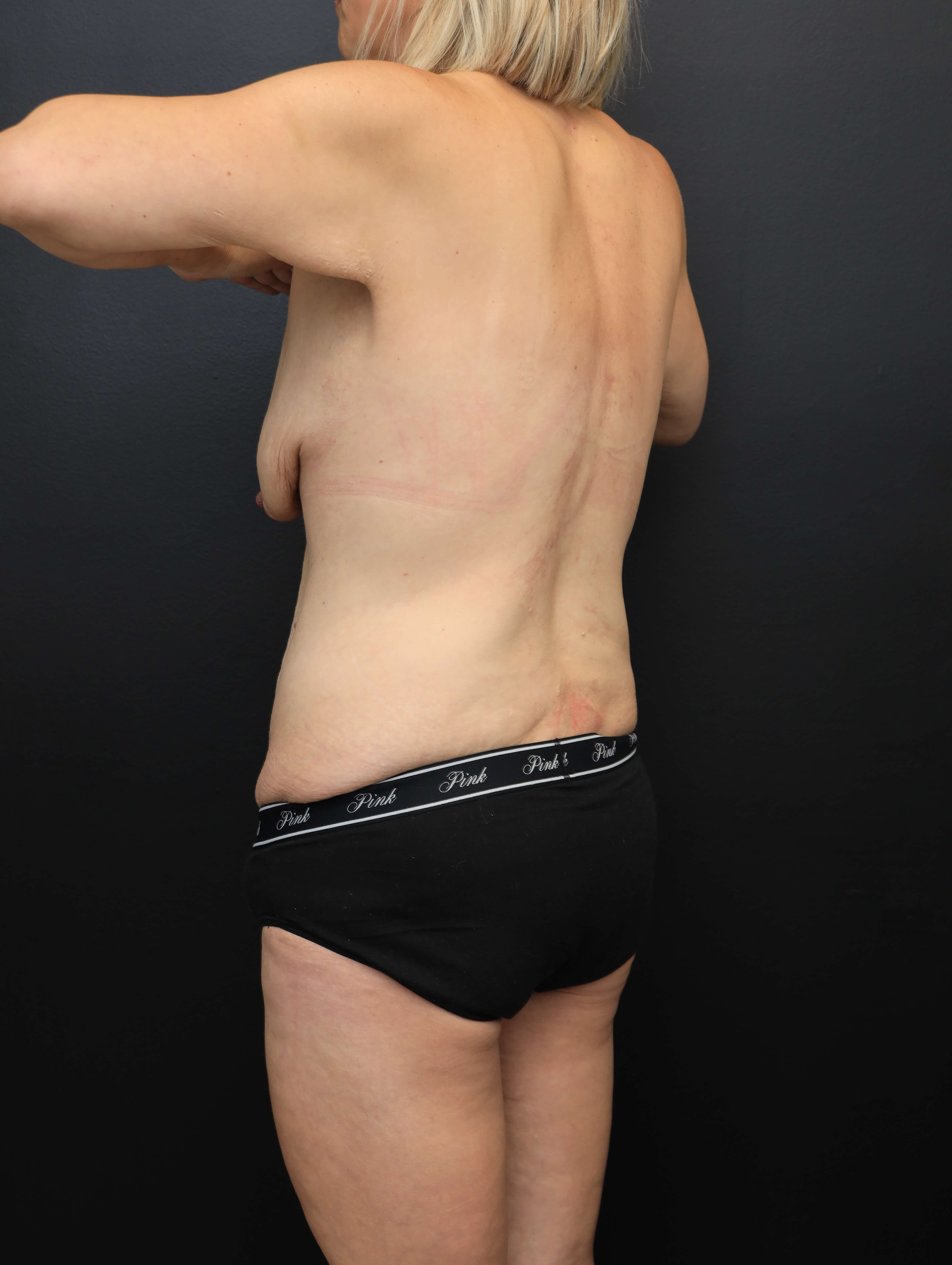 Left Posterior Oblique Before
