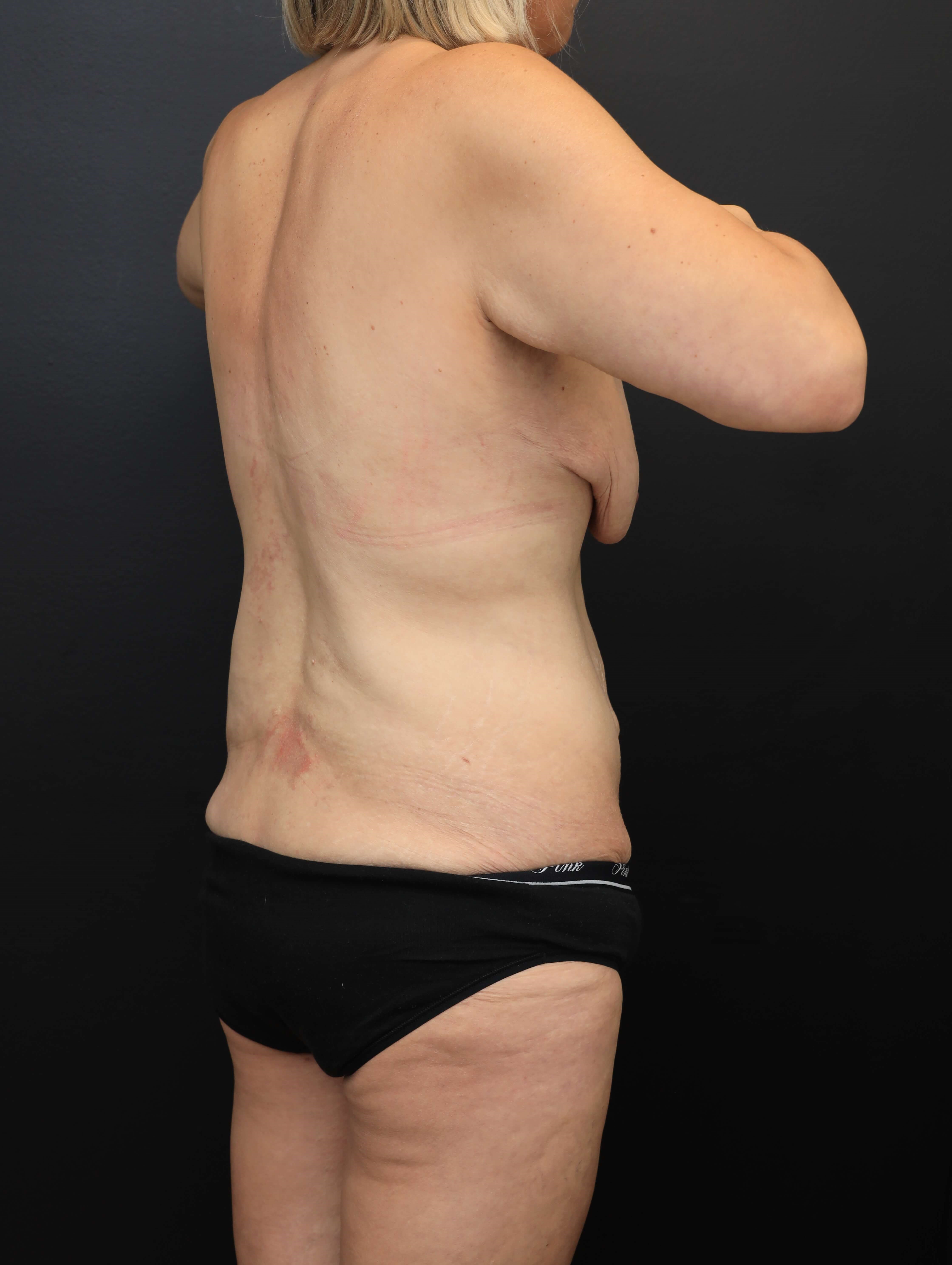Right Posterior Oblique Before