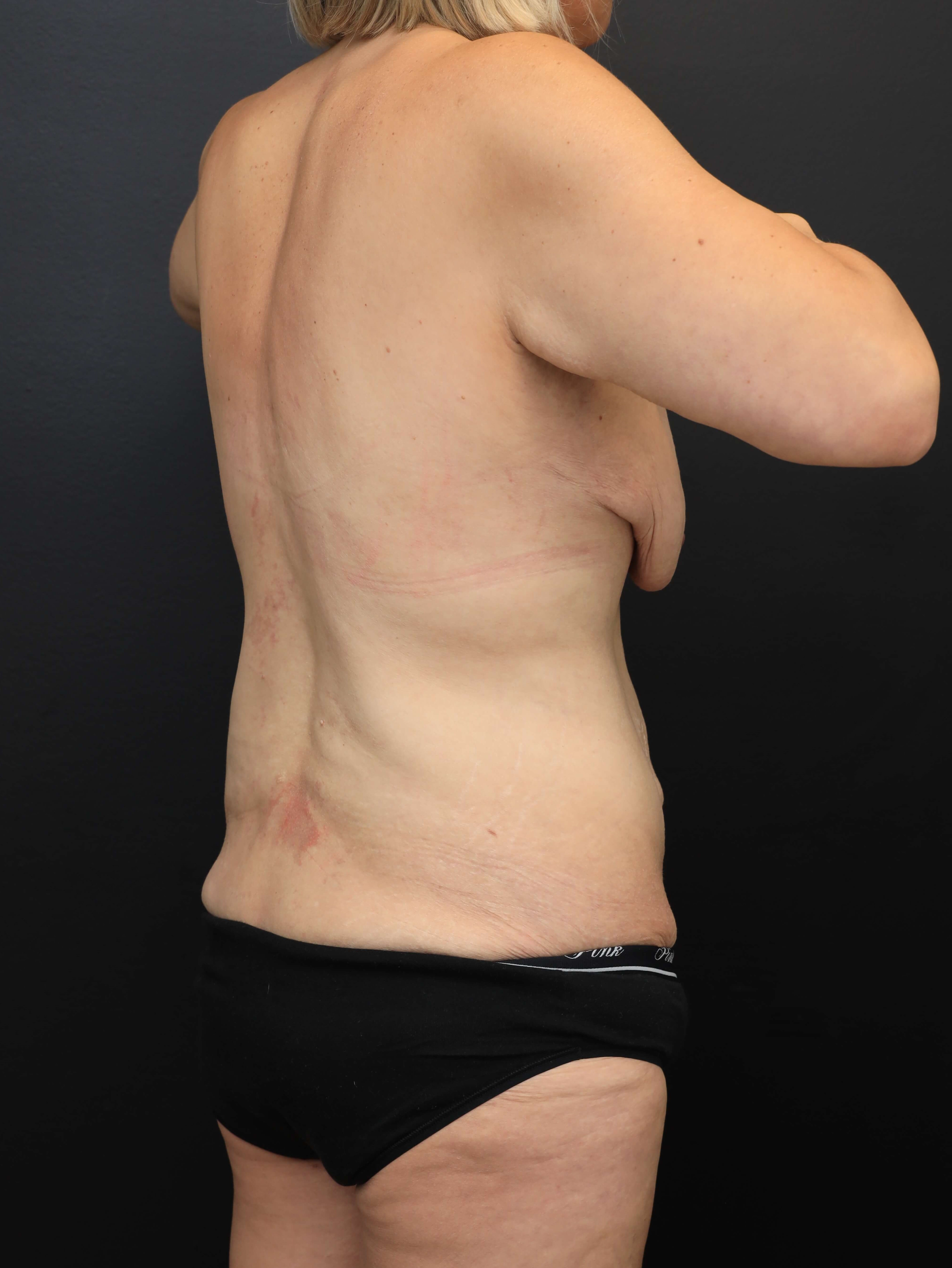 Right Posterior Oblique Before
