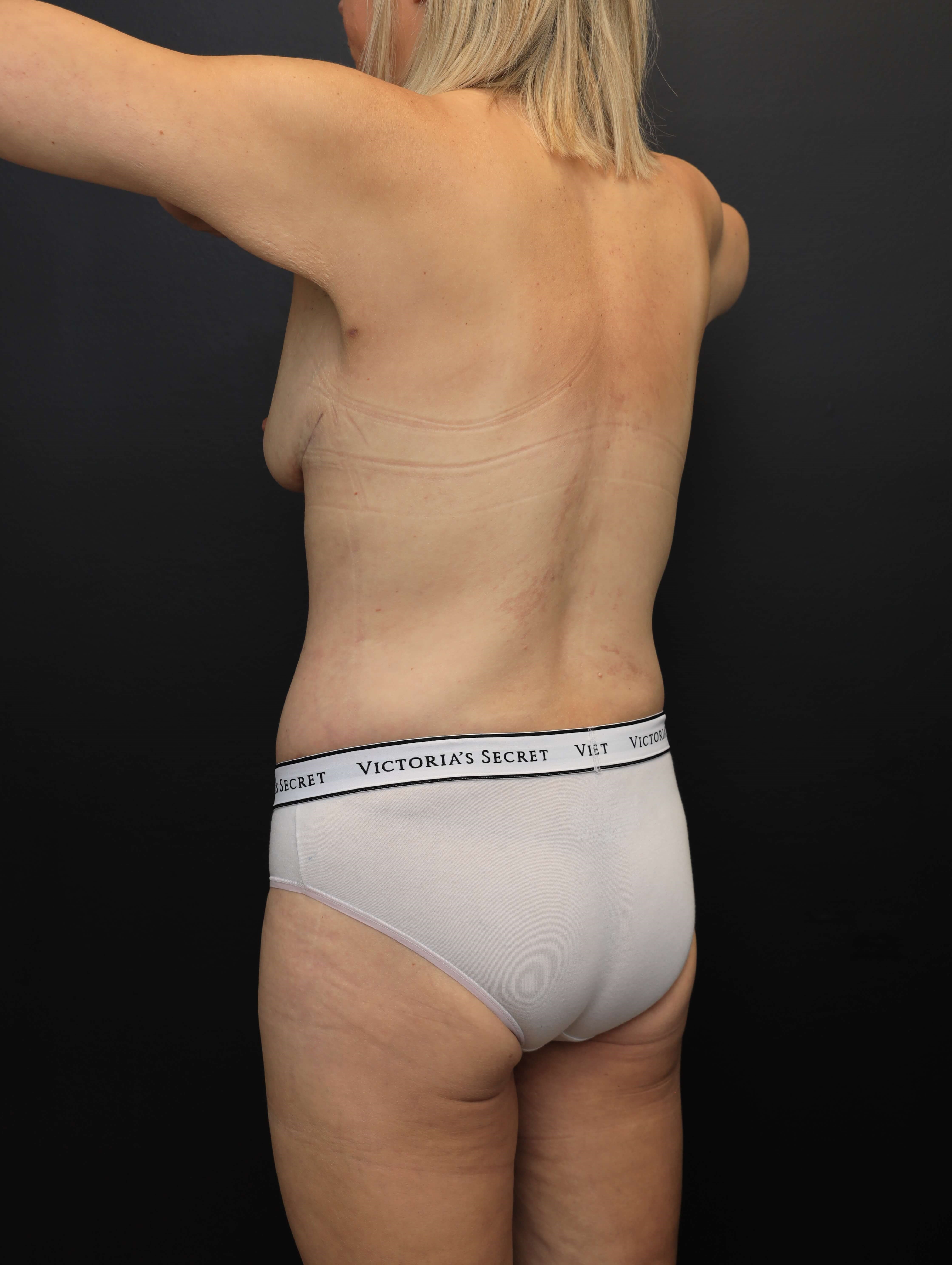 Left Posterior Oblique After