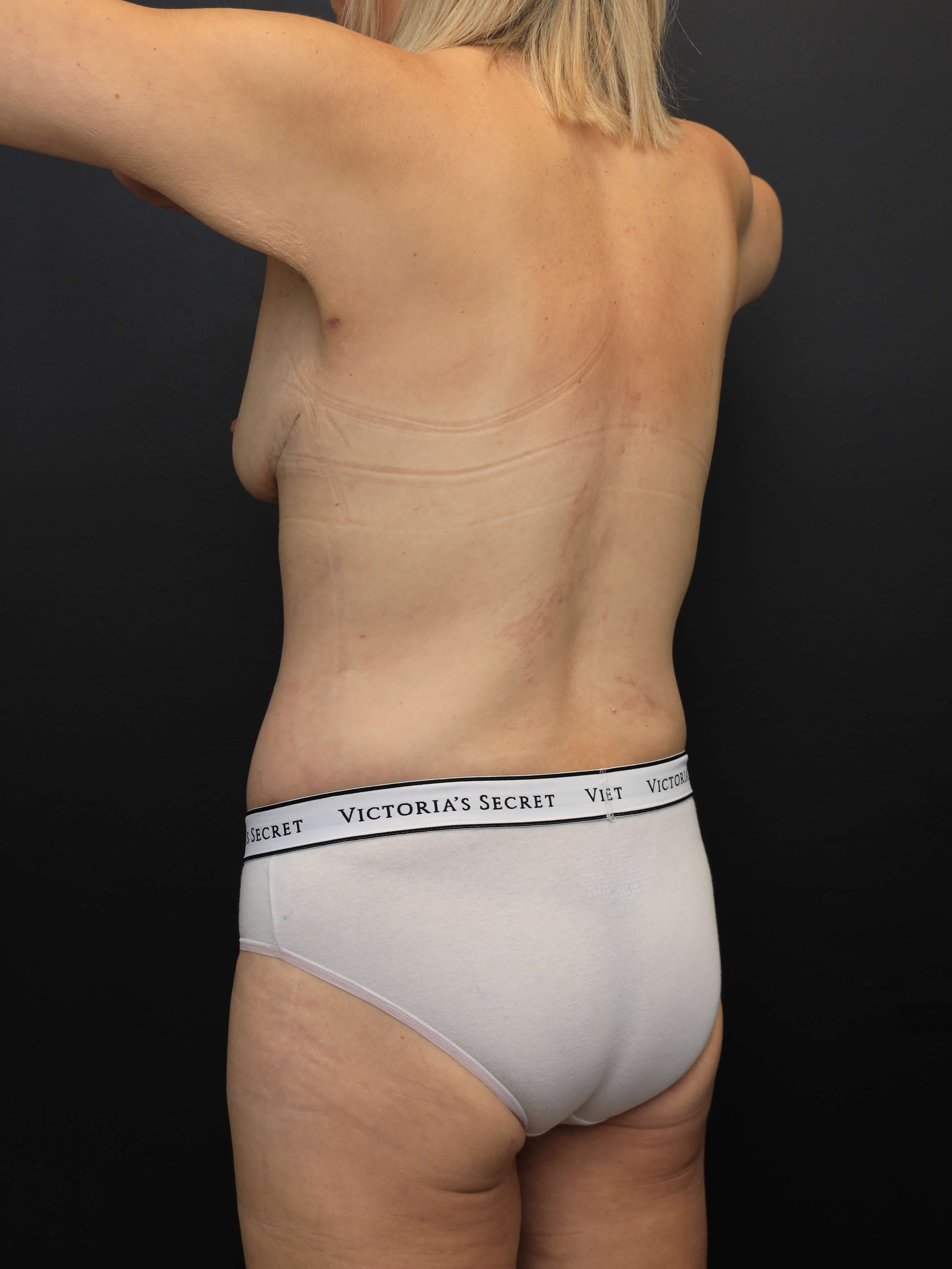 Left Posterior Oblique After