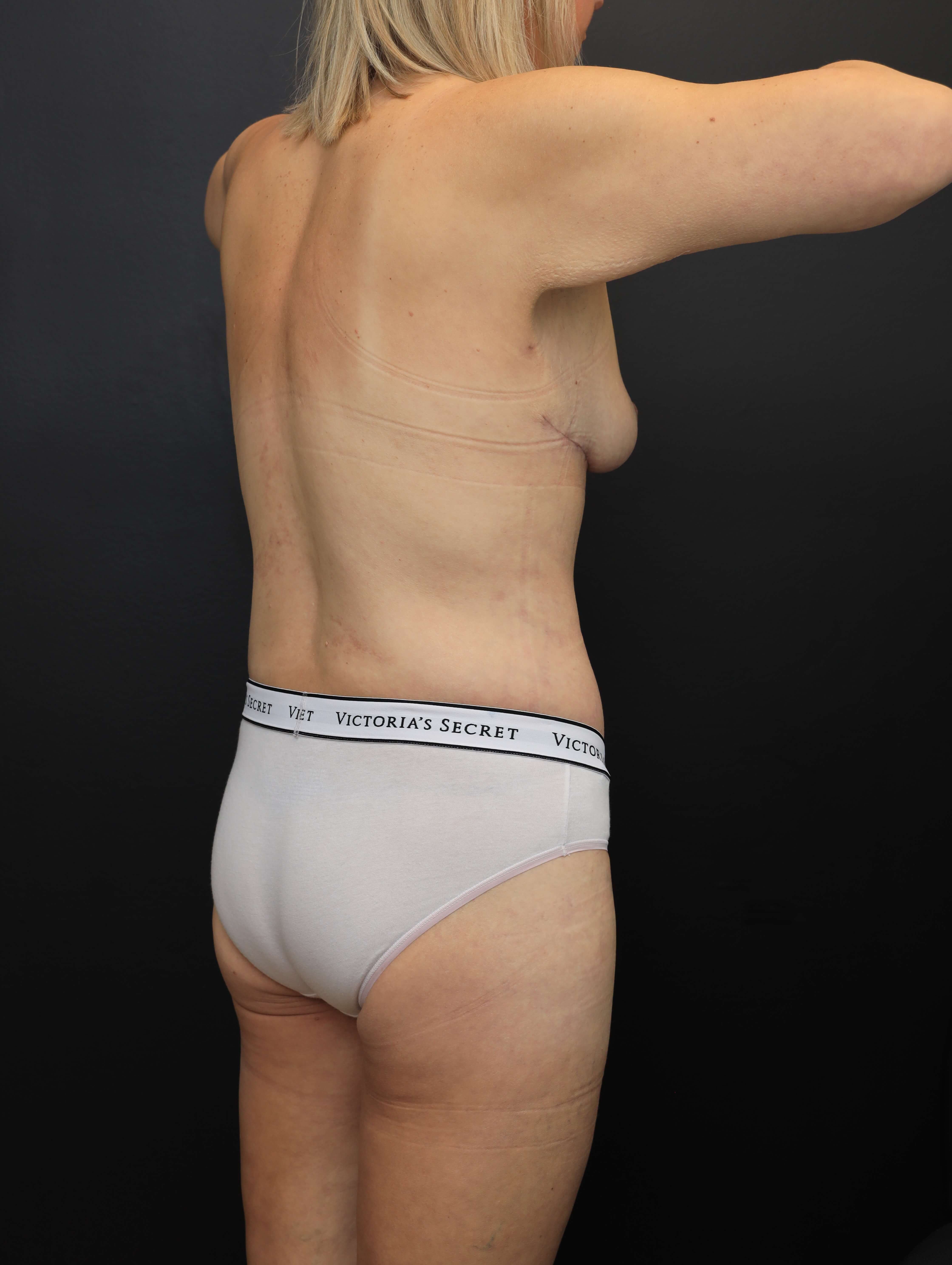 Right Posterior Oblique After