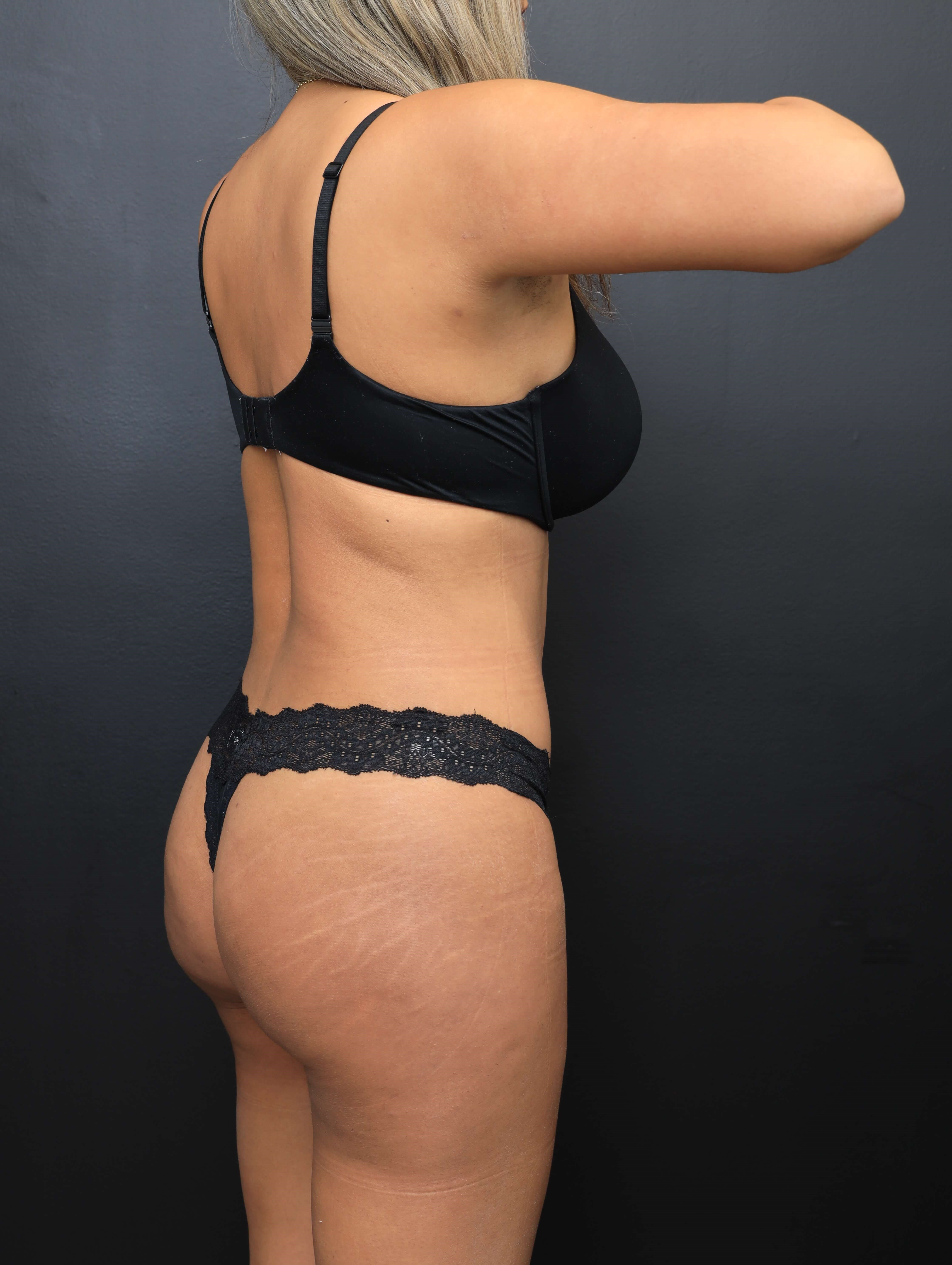 Right Posterior Oblique After