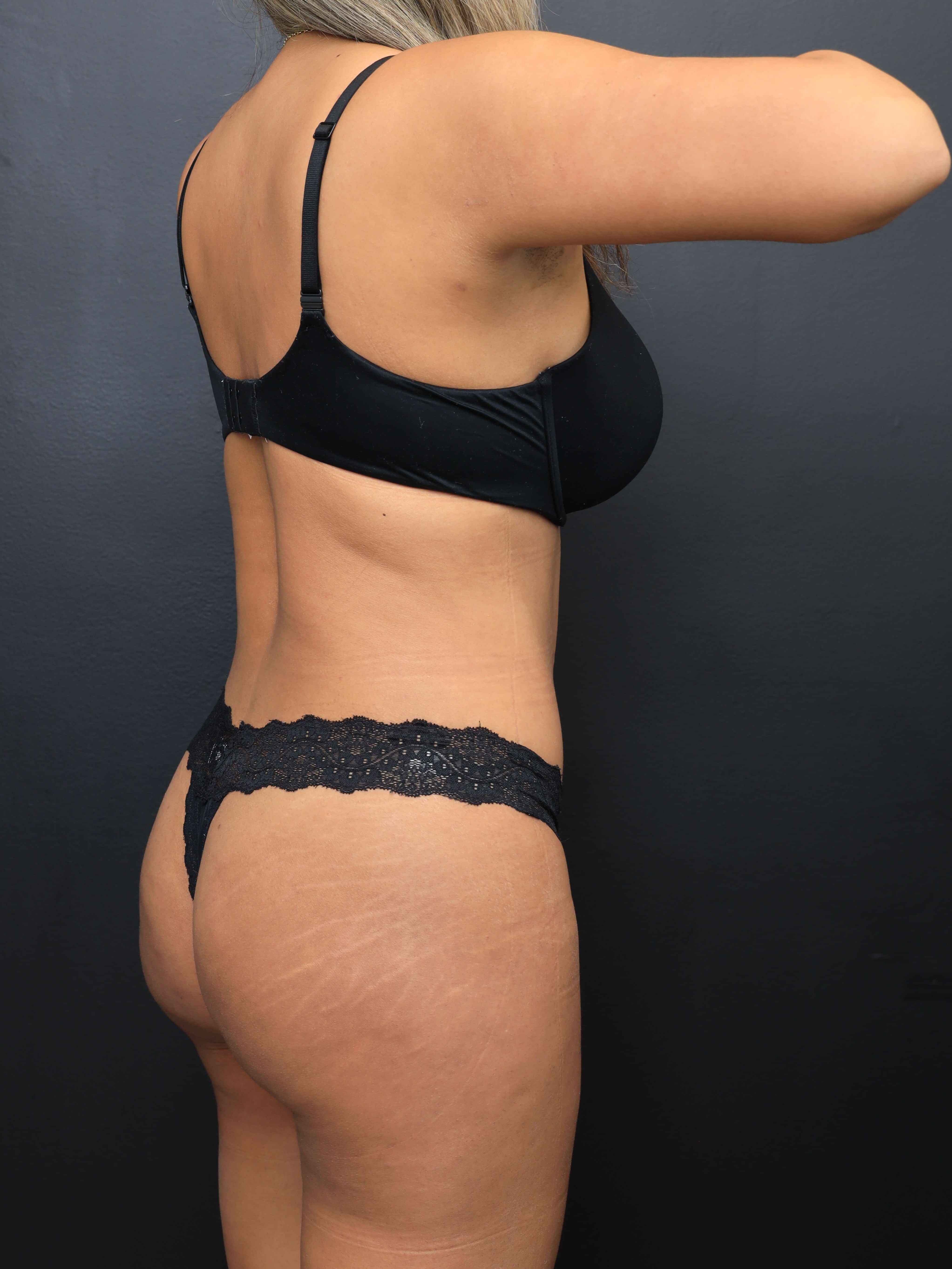 Right Posterior Oblique After