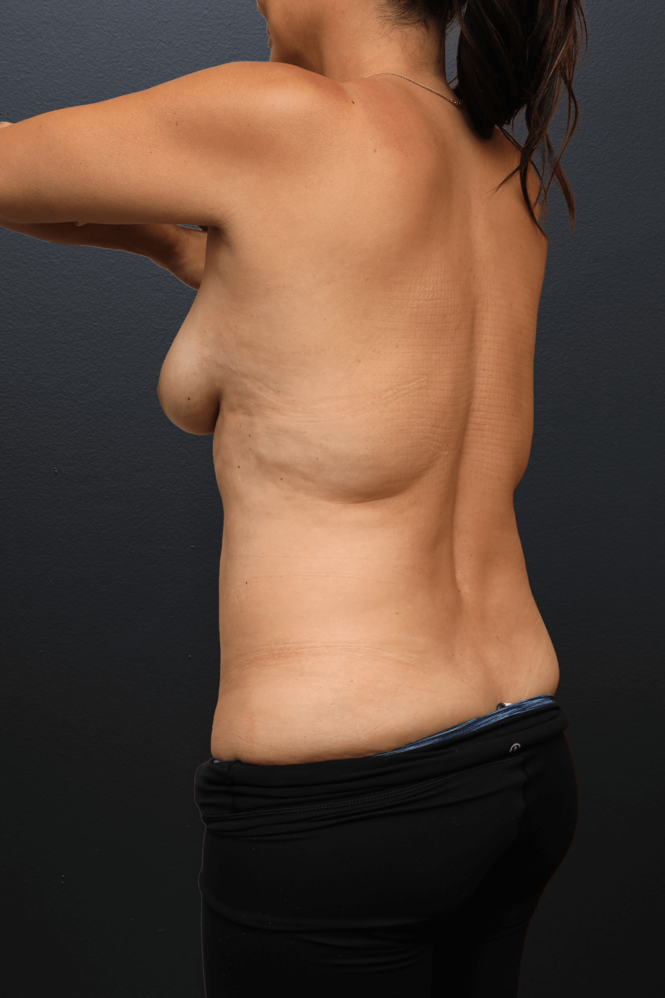 Left Posterior Oblique Before