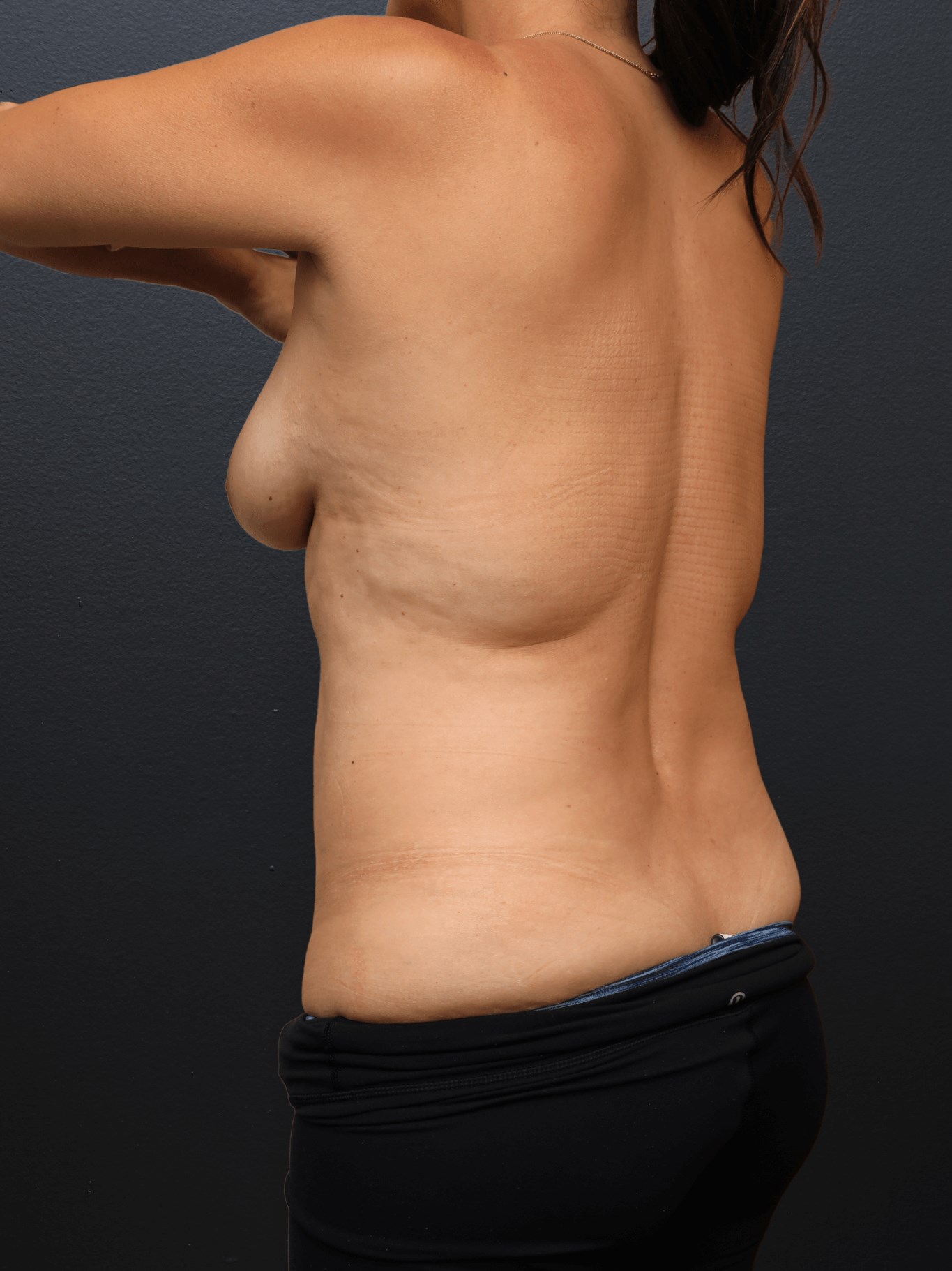 Left Posterior Oblique Before