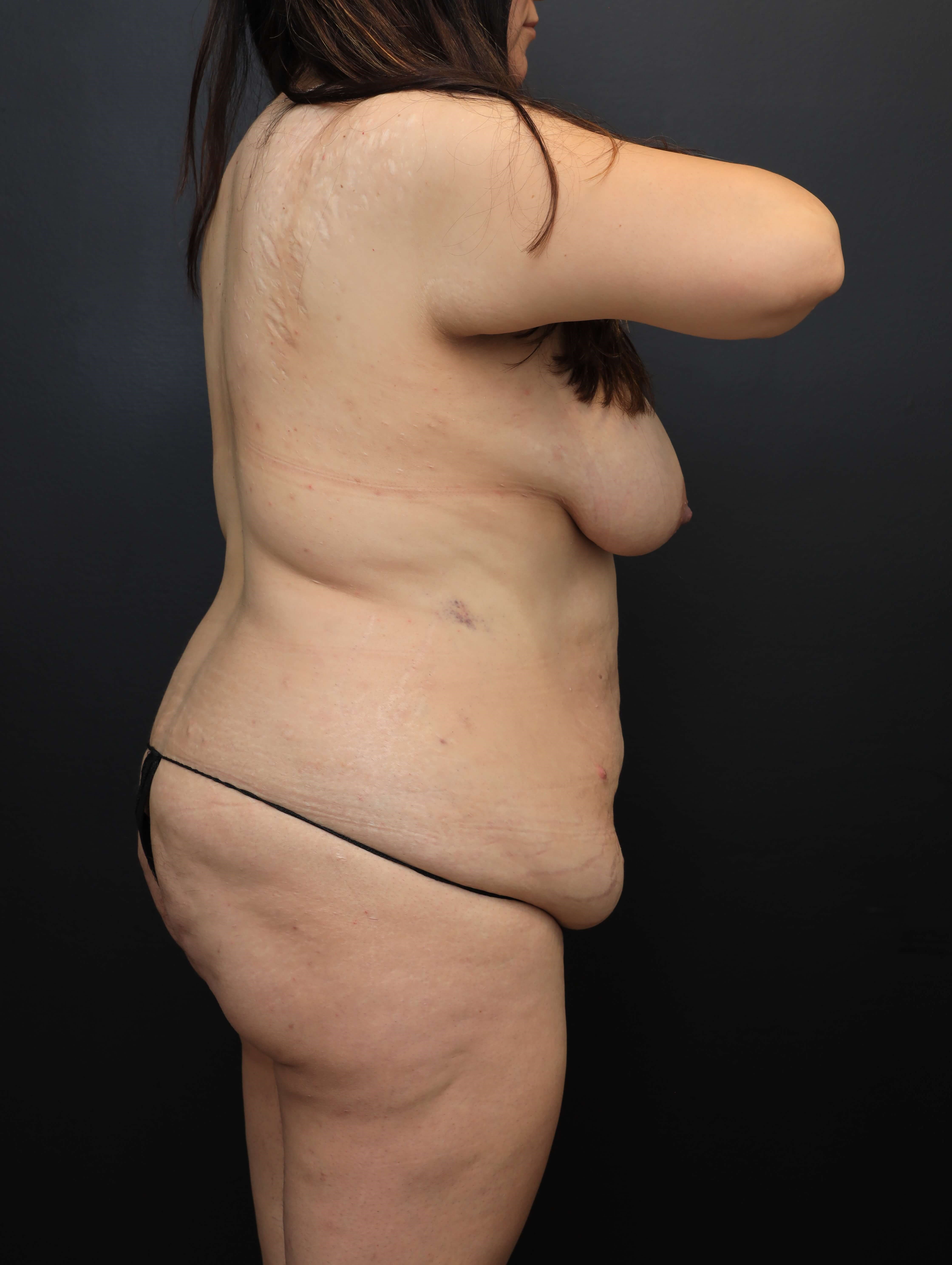 Right Posterior Oblique Before