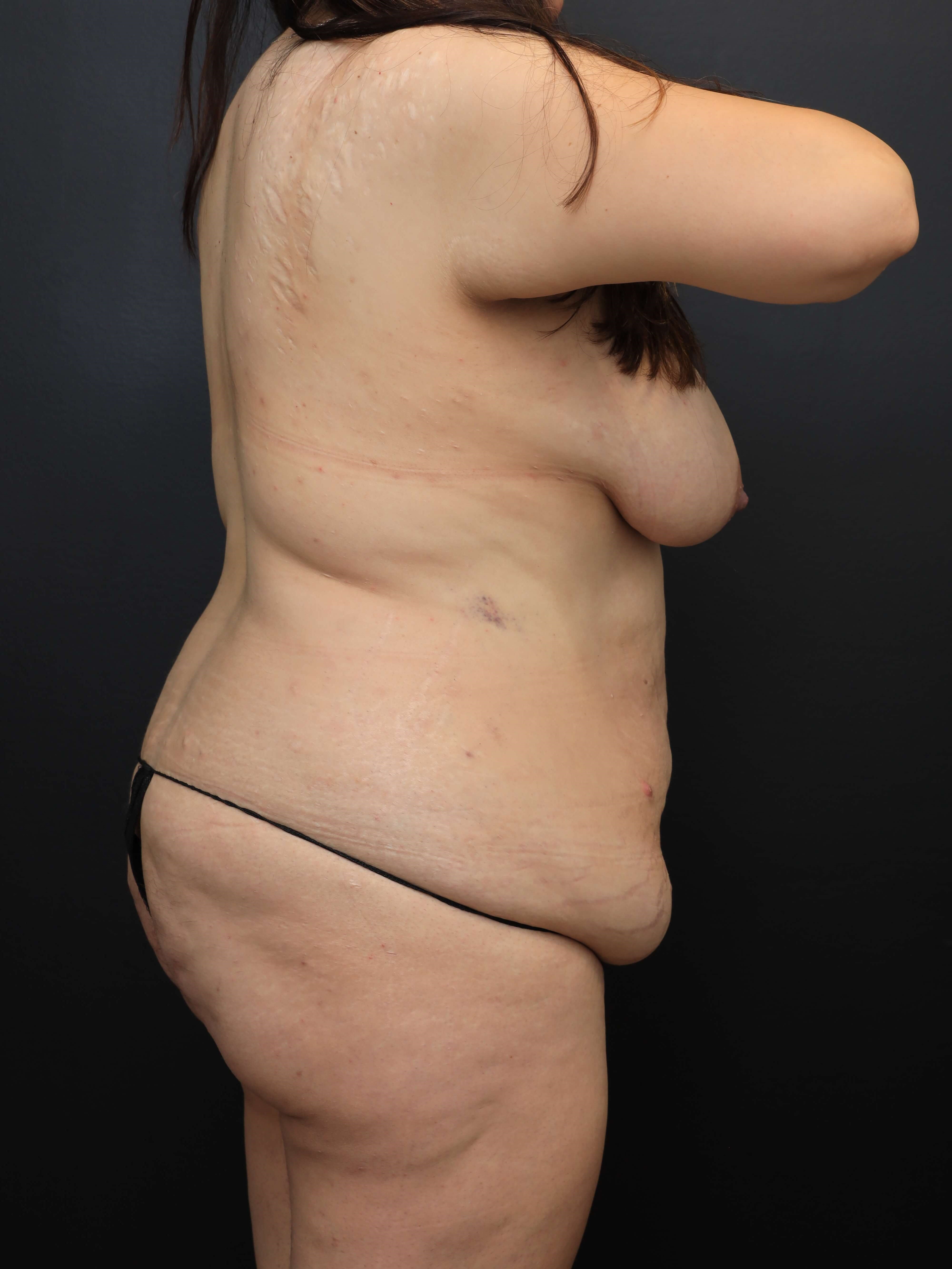Right Posterior Oblique Before