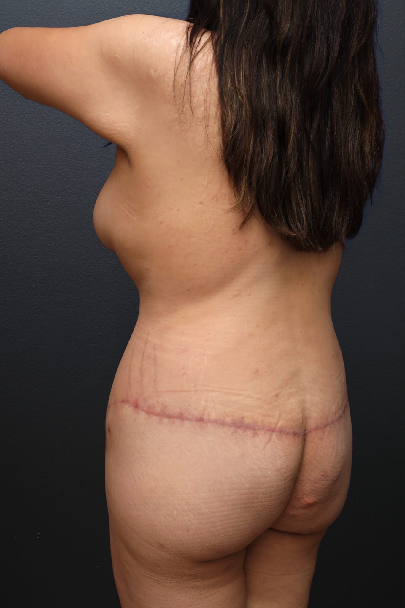 Left Posterior Oblique After