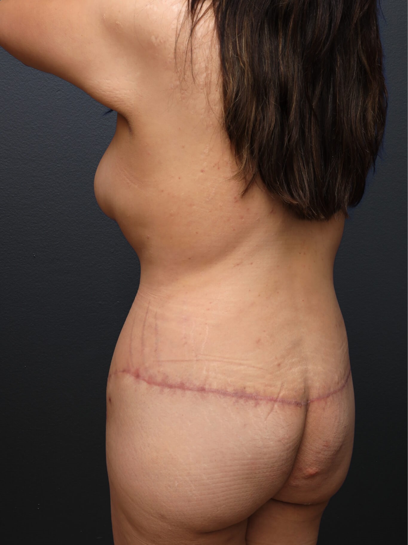 Left Posterior Oblique After