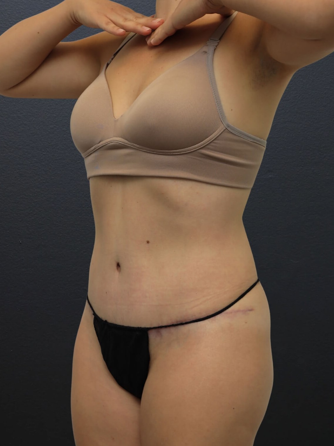 Left Oblique After