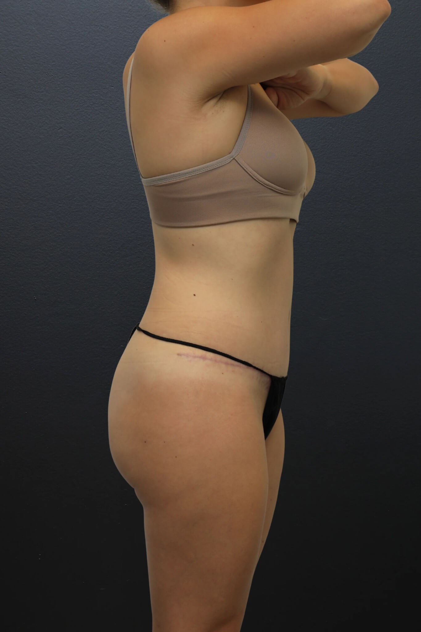 Right Lateral After