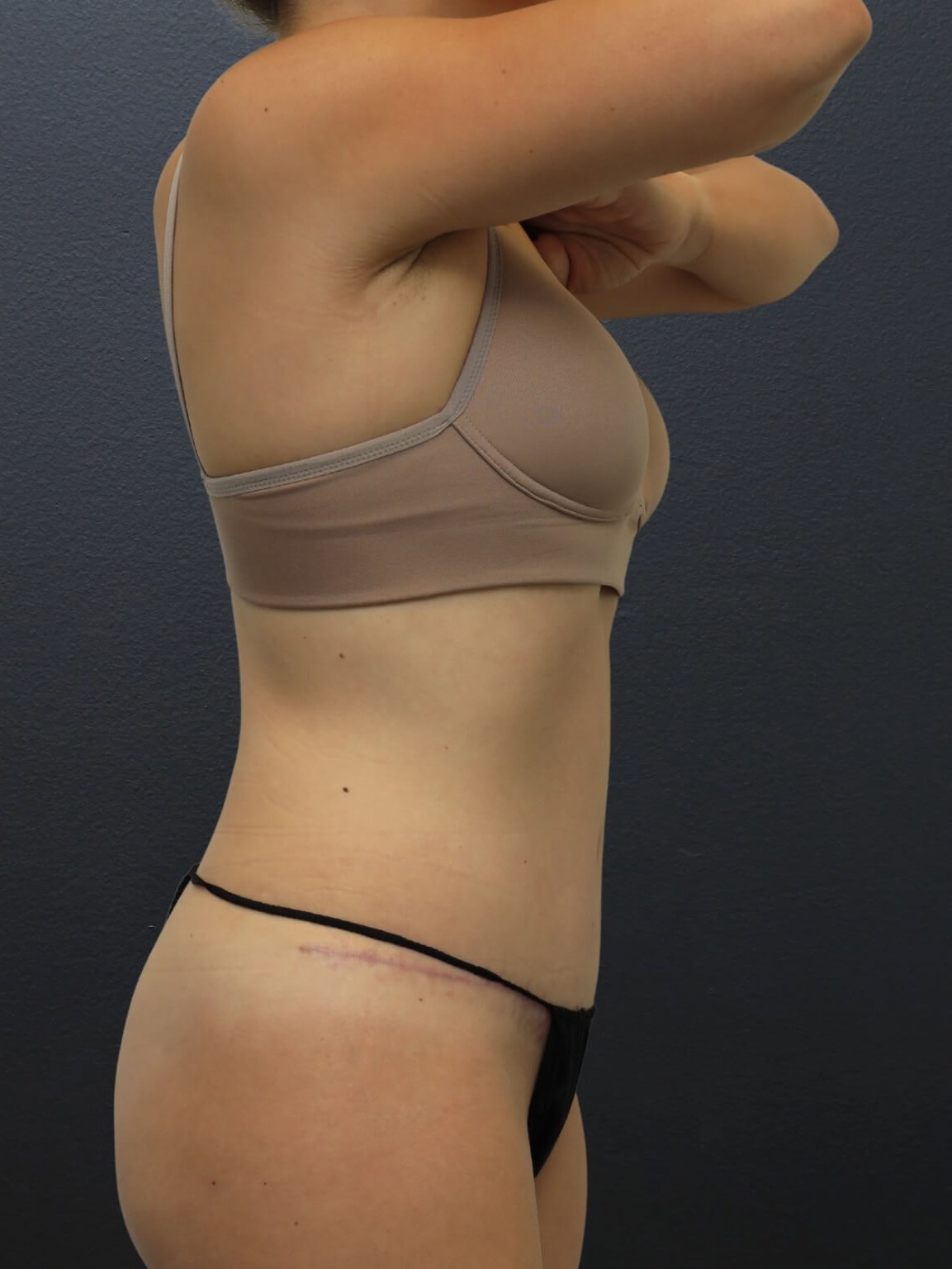 Right Lateral After