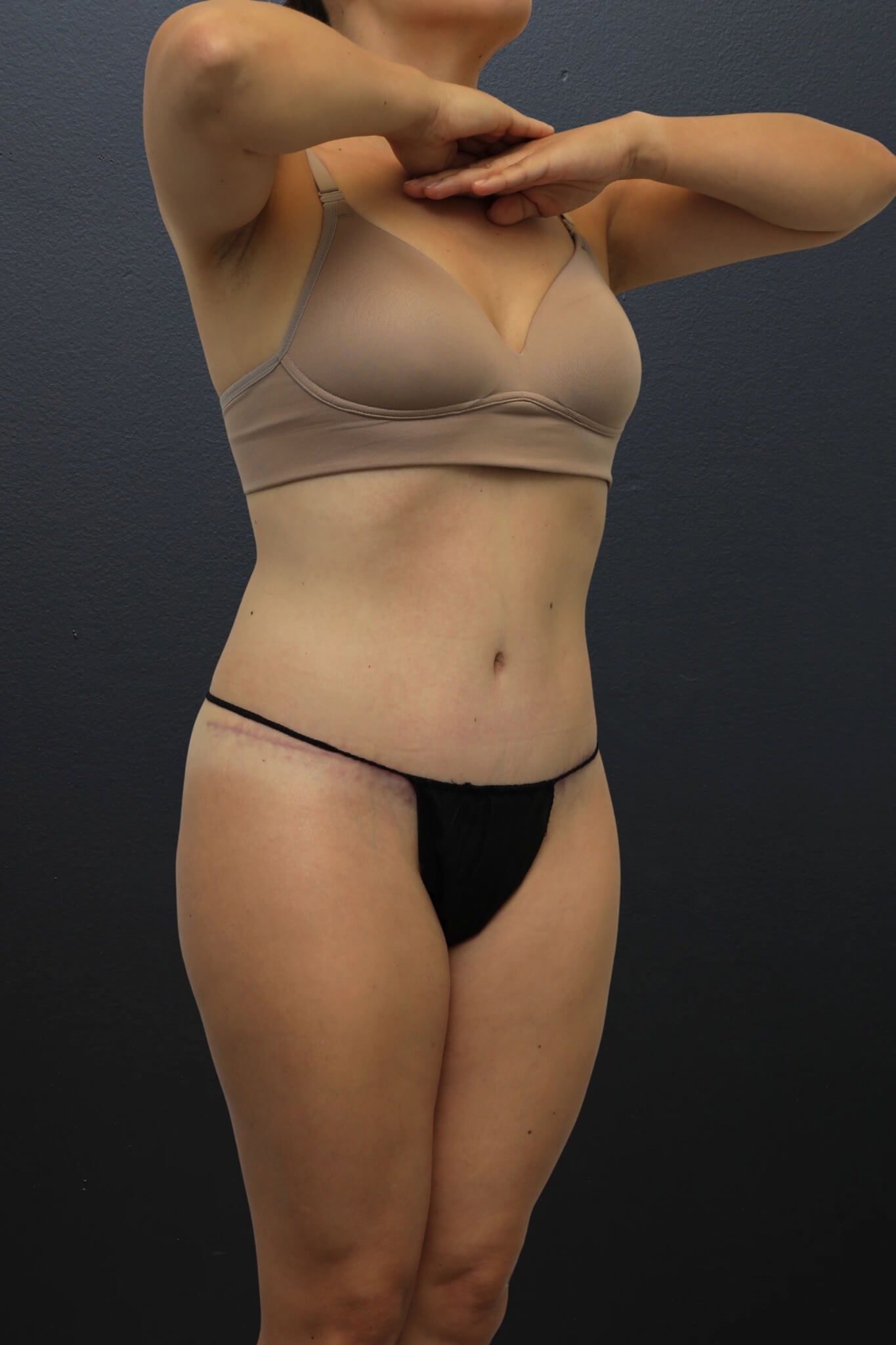 Right Oblique After