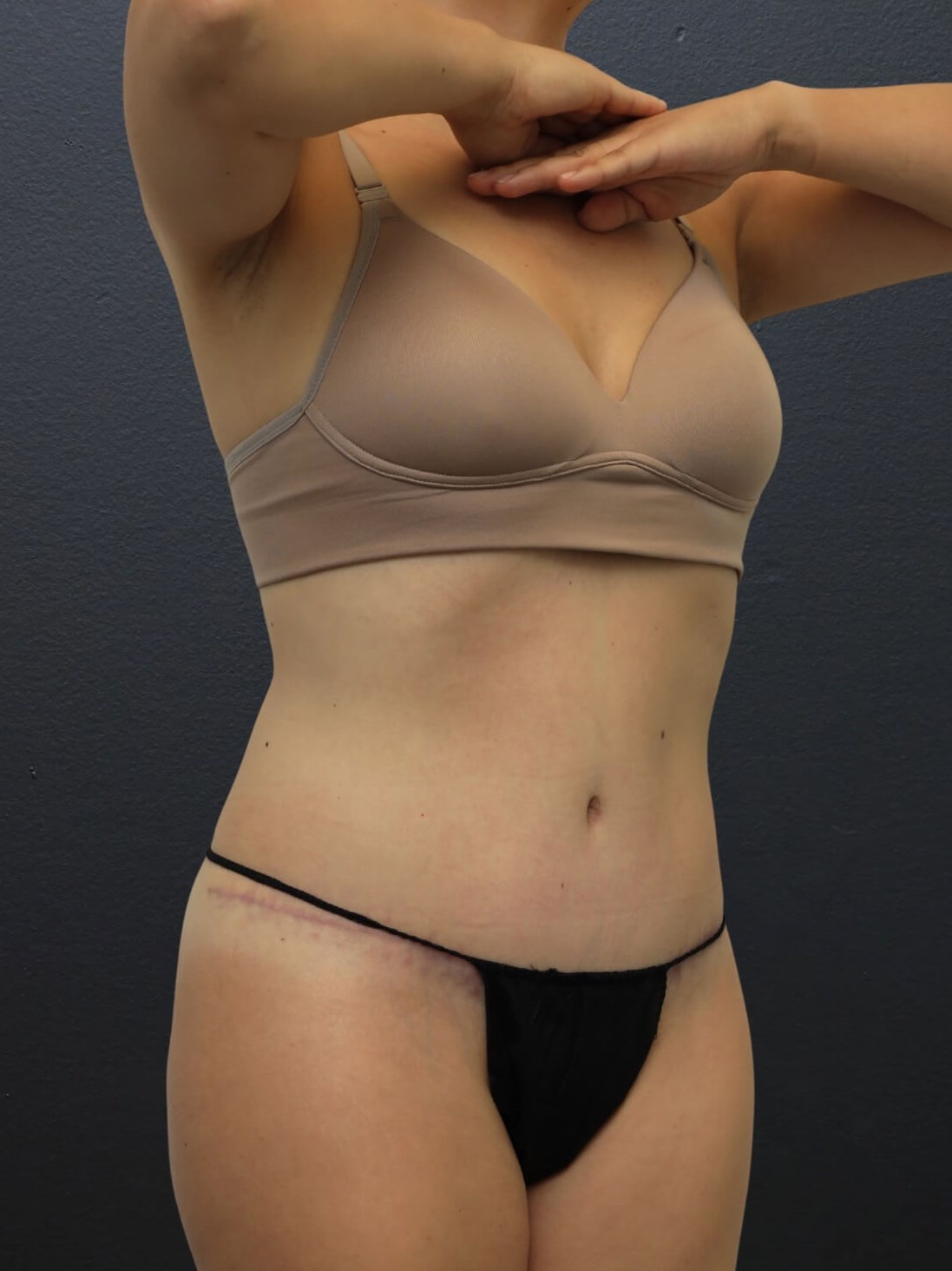 Right Oblique After