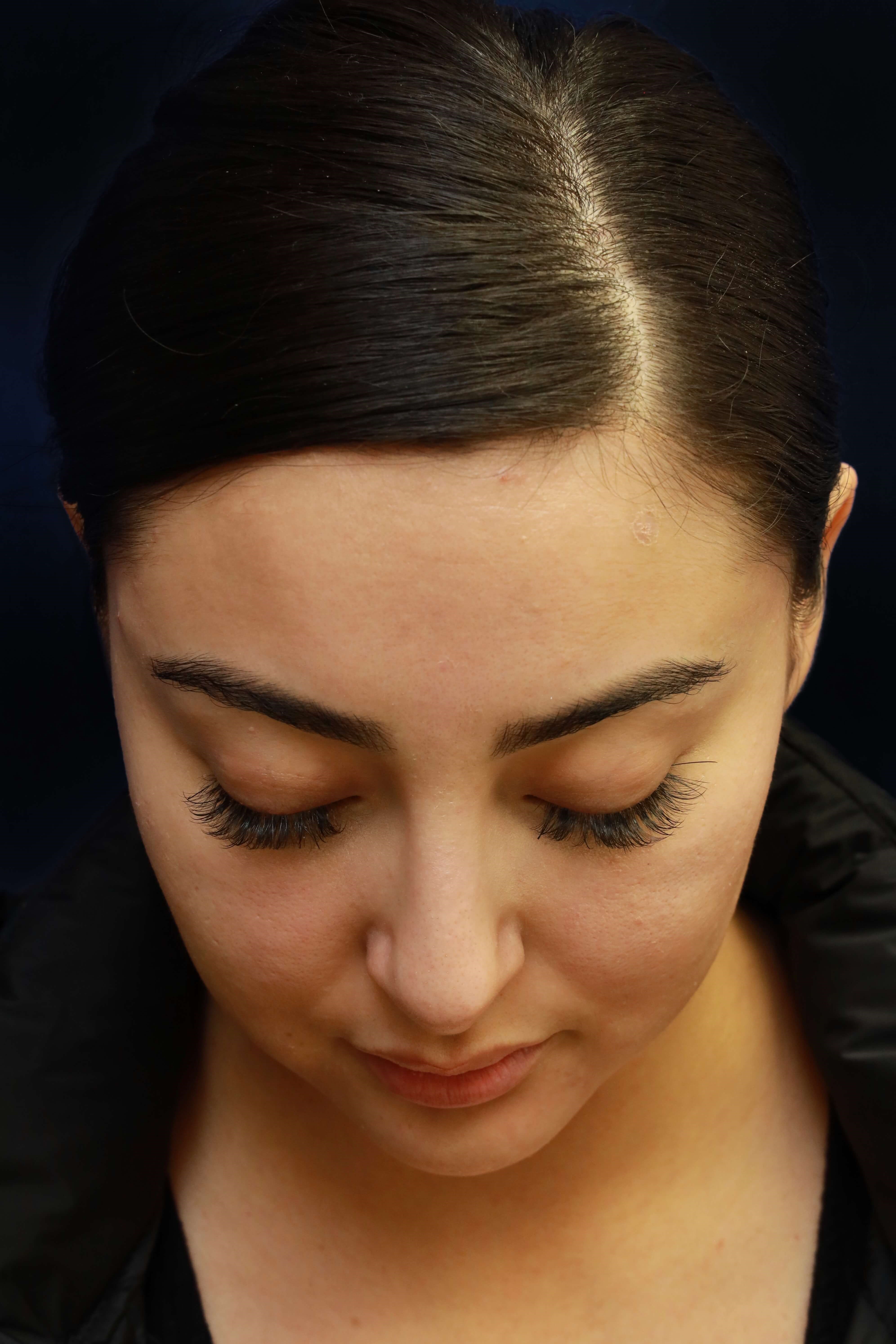 NASAL DORSUM After