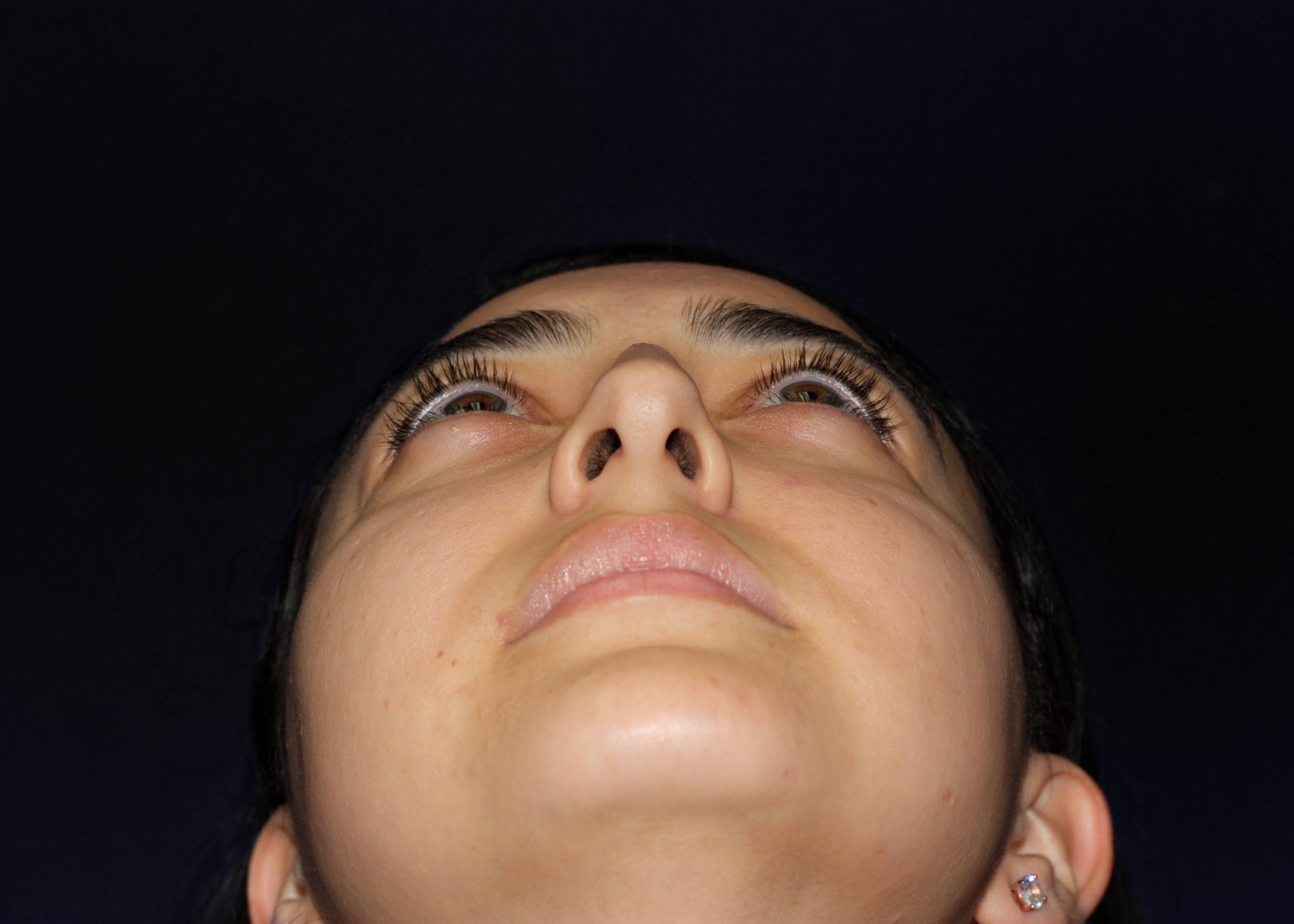 NASAL BASE Before