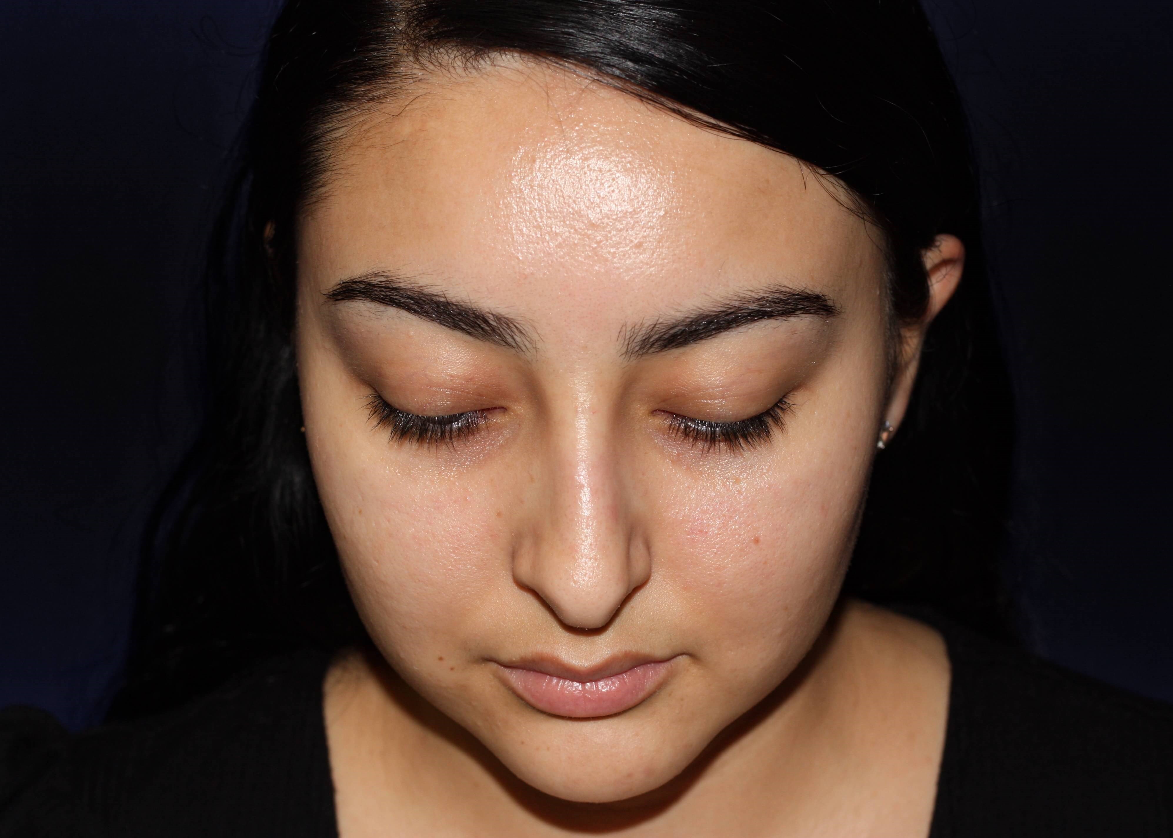 NASAL DORSUM Before