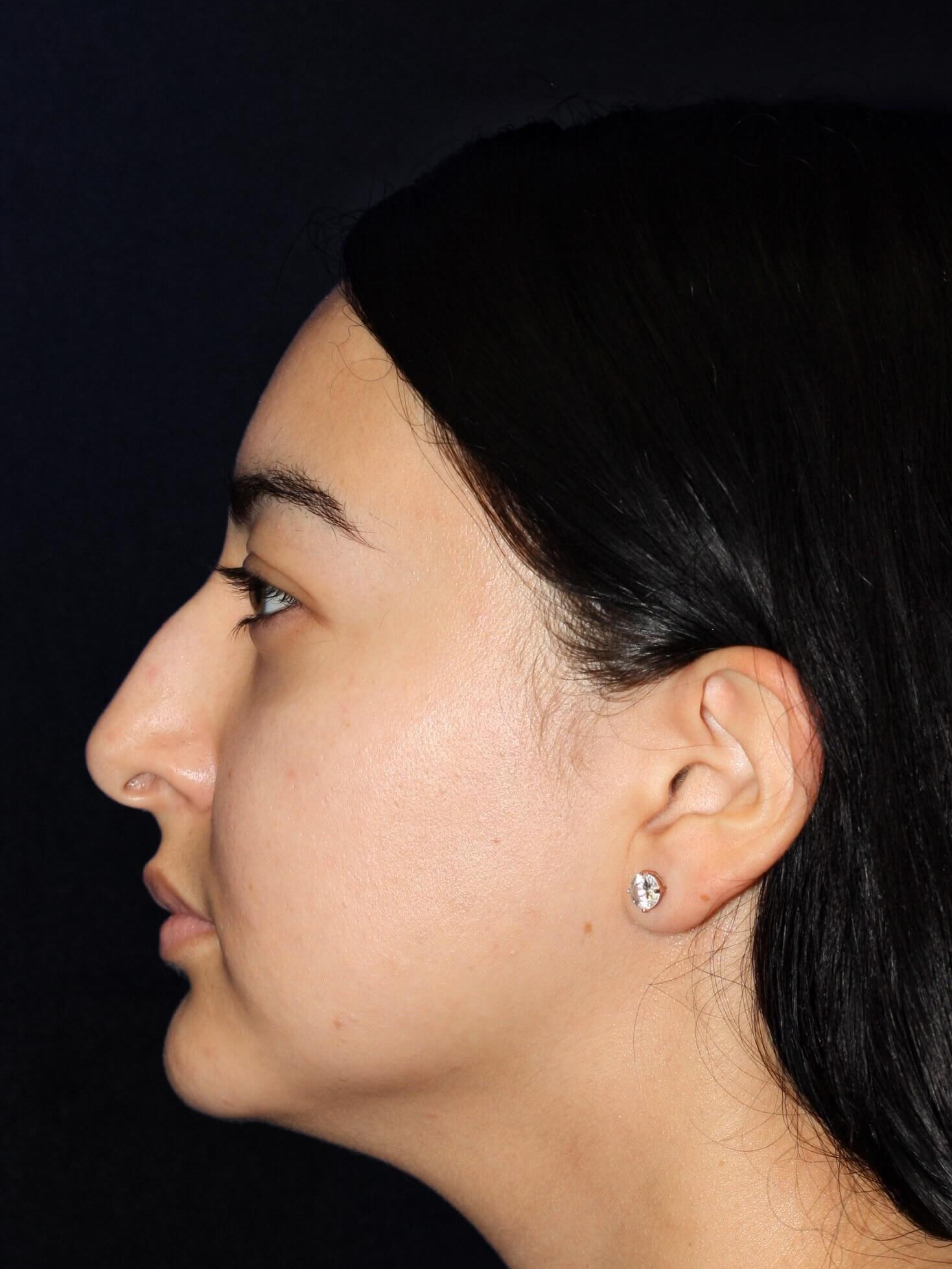 LEFT LATERAL Before