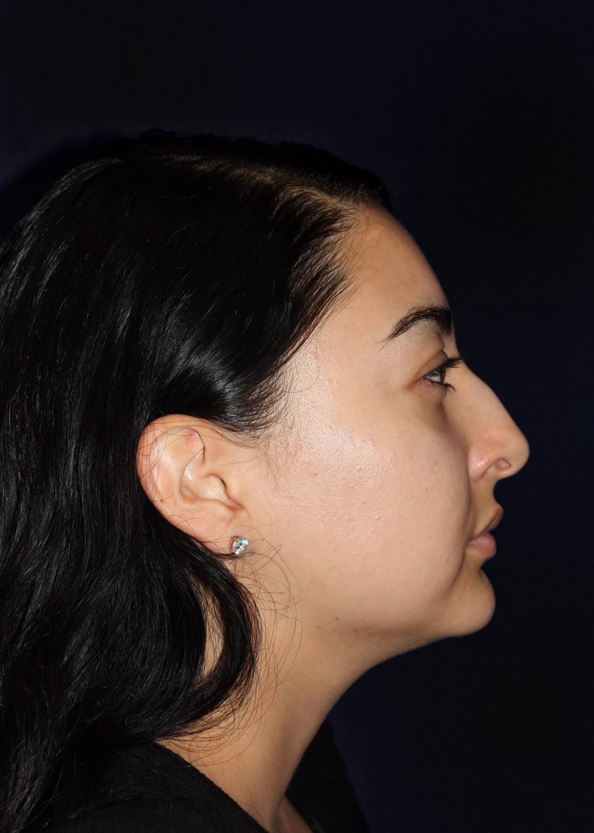 RIGHT LATERAL Before