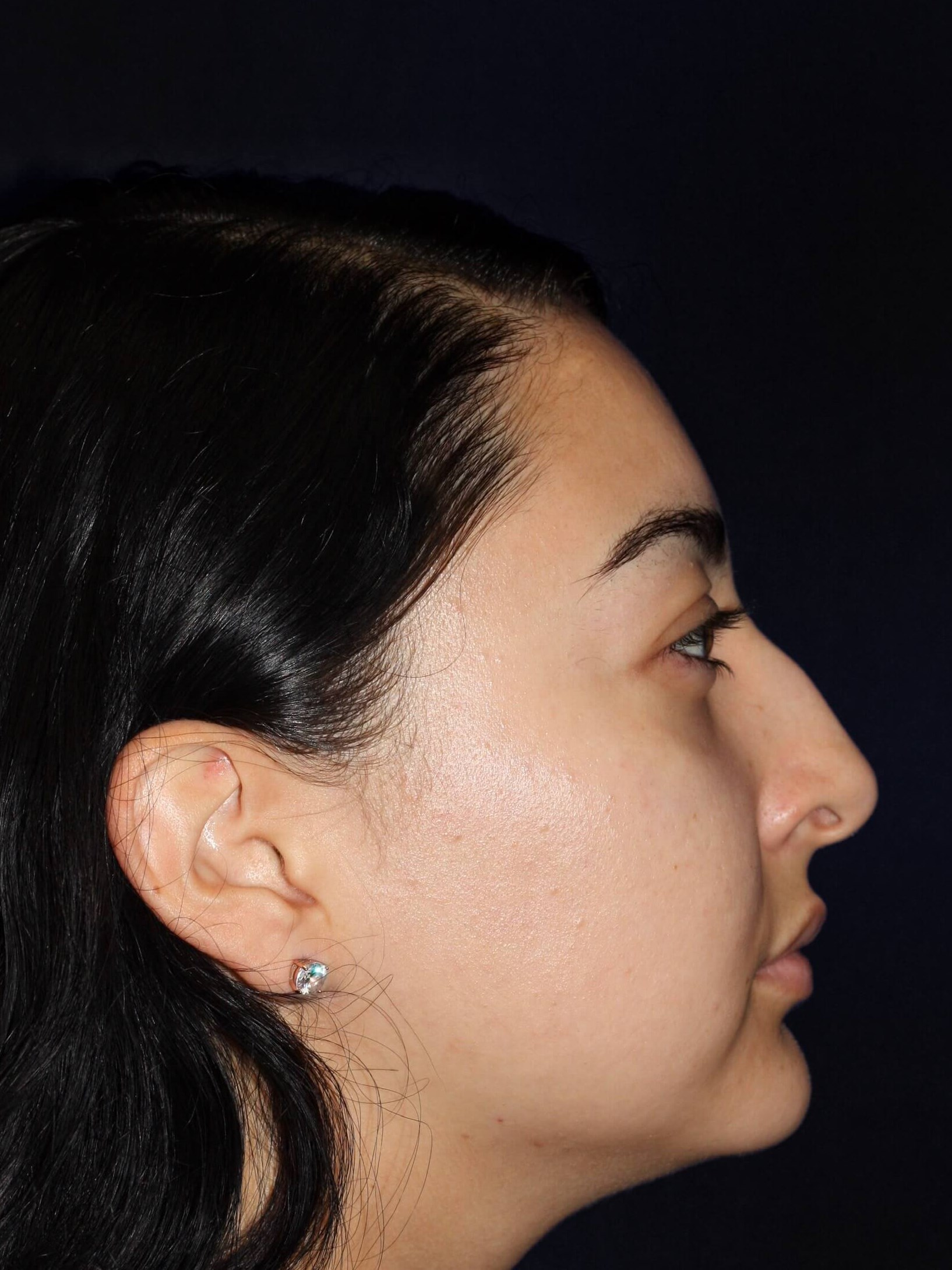 RIGHT LATERAL Before