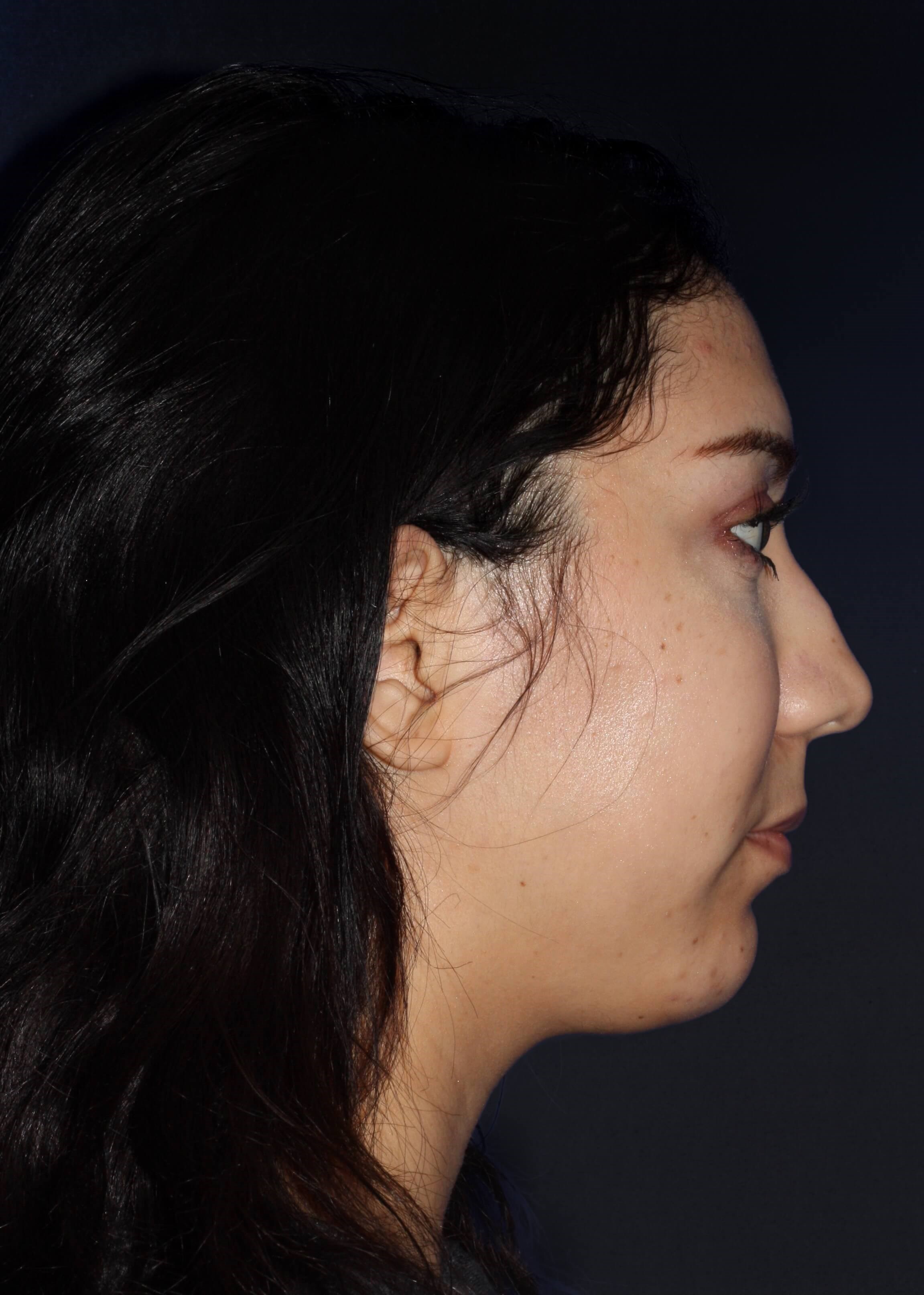 RIGHT LATERAL Before