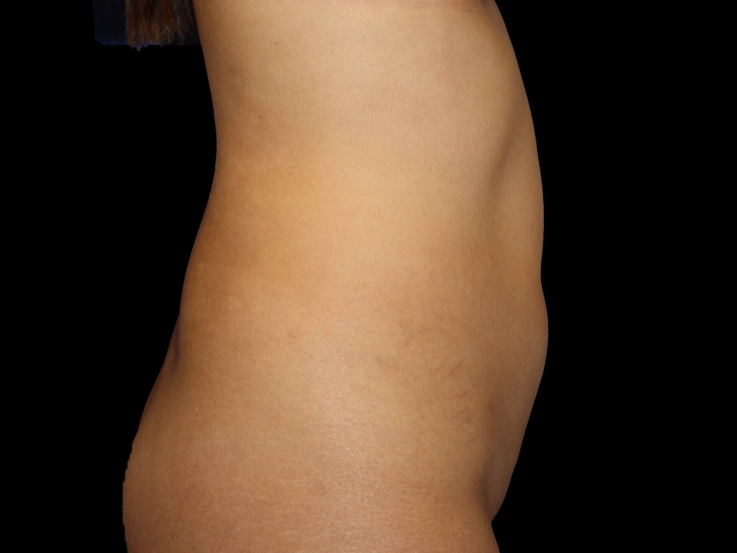 Right lateral Before