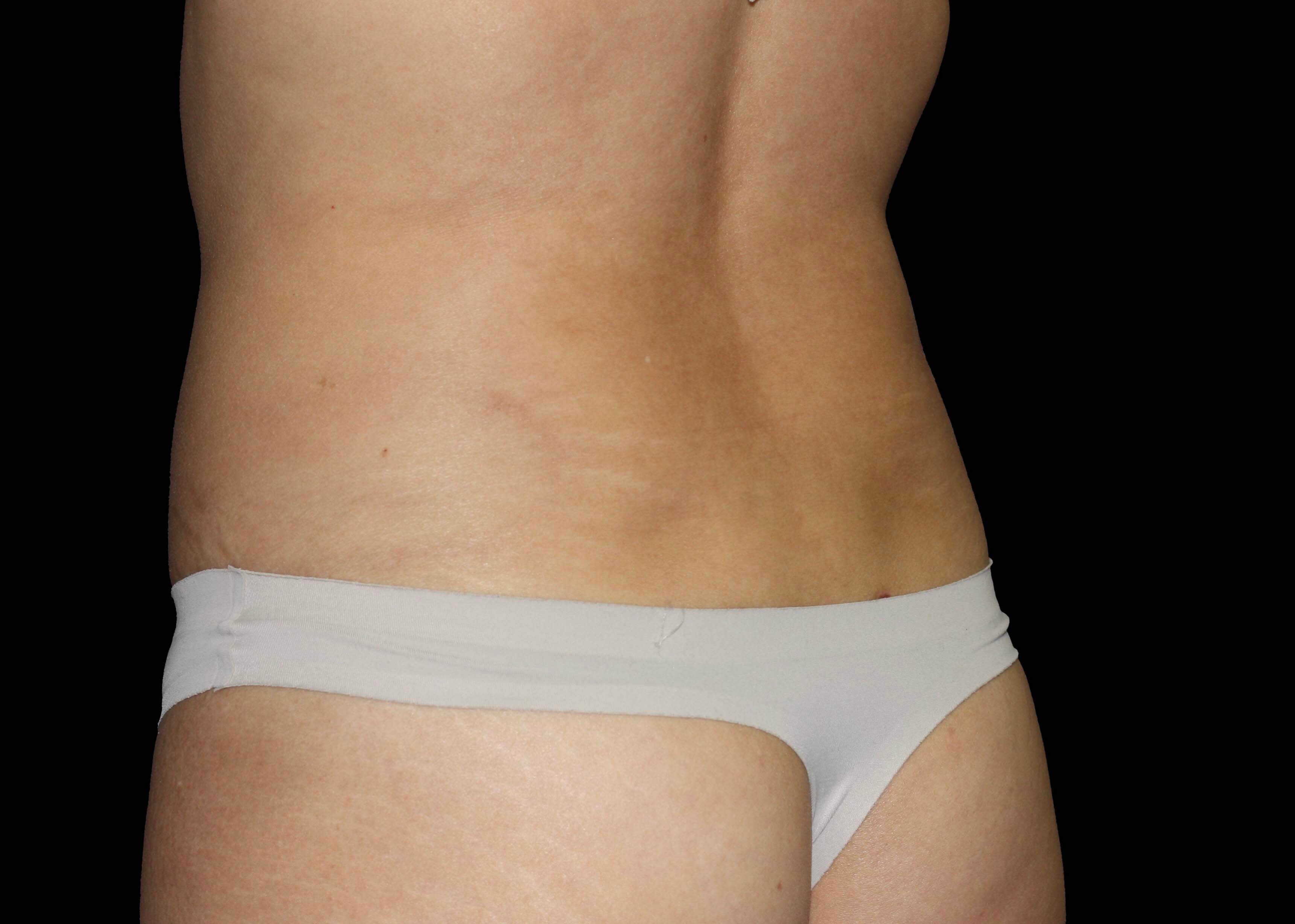 Left back oblique After