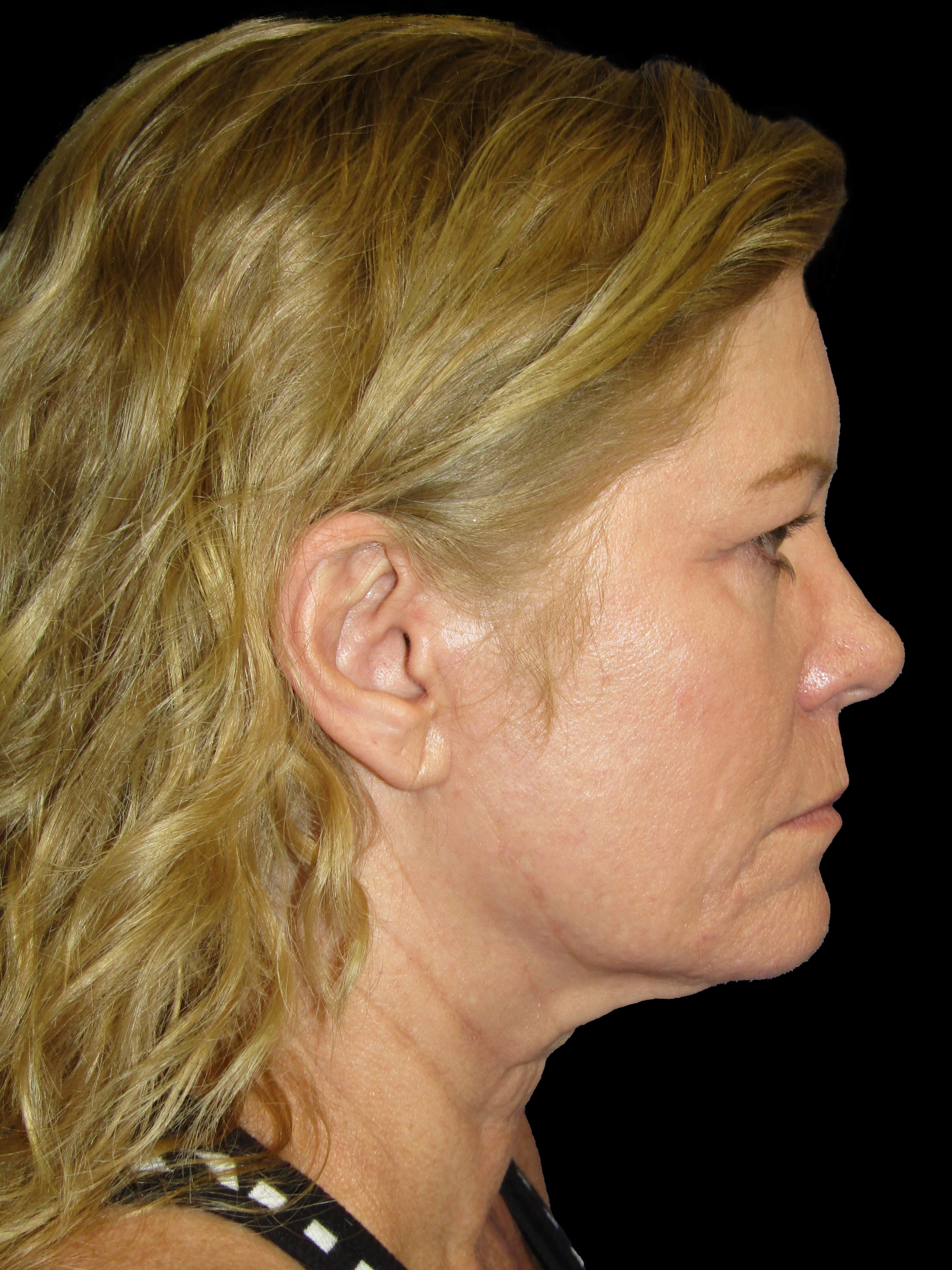 Right lateral Before