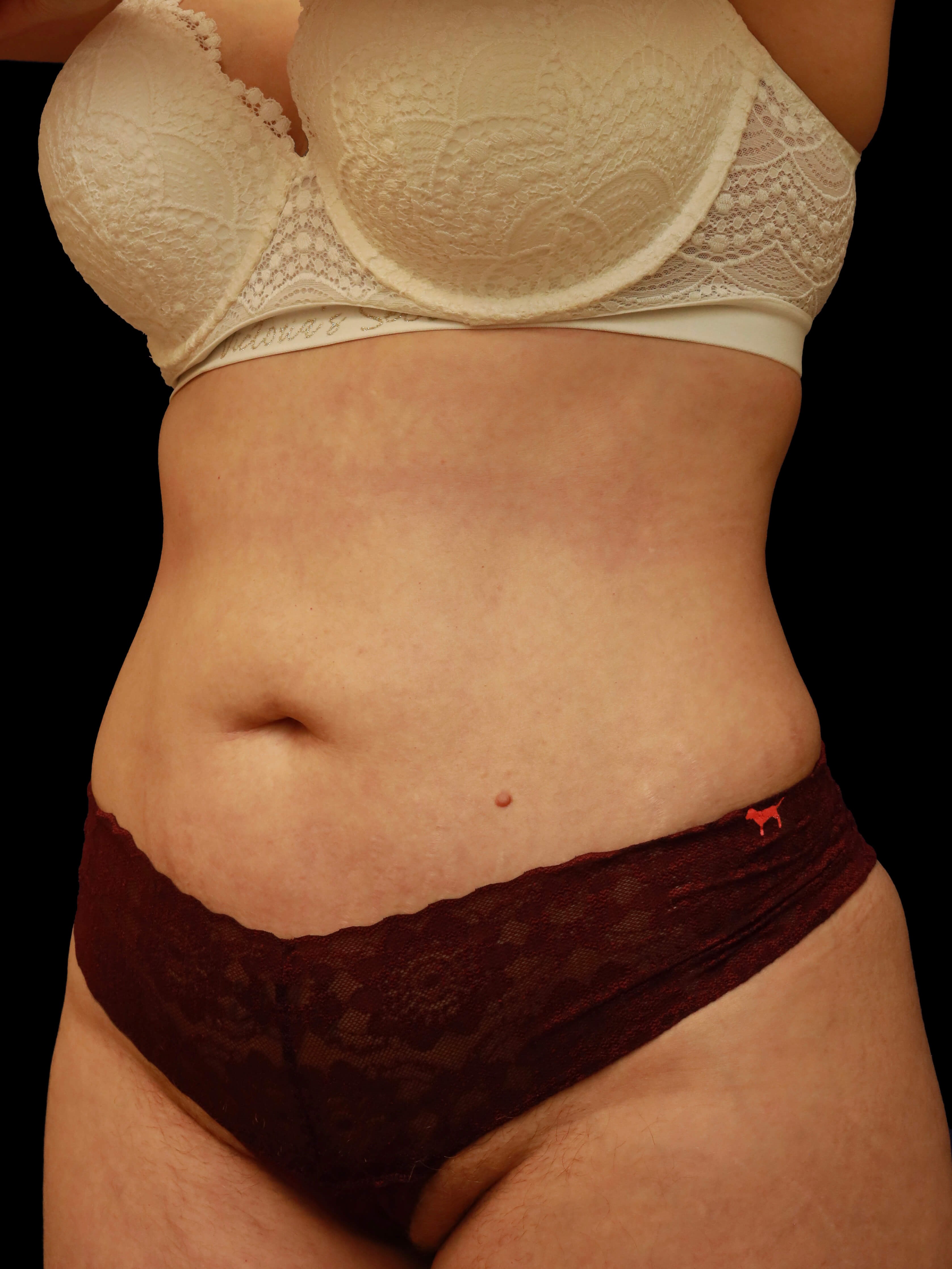 Left oblique After