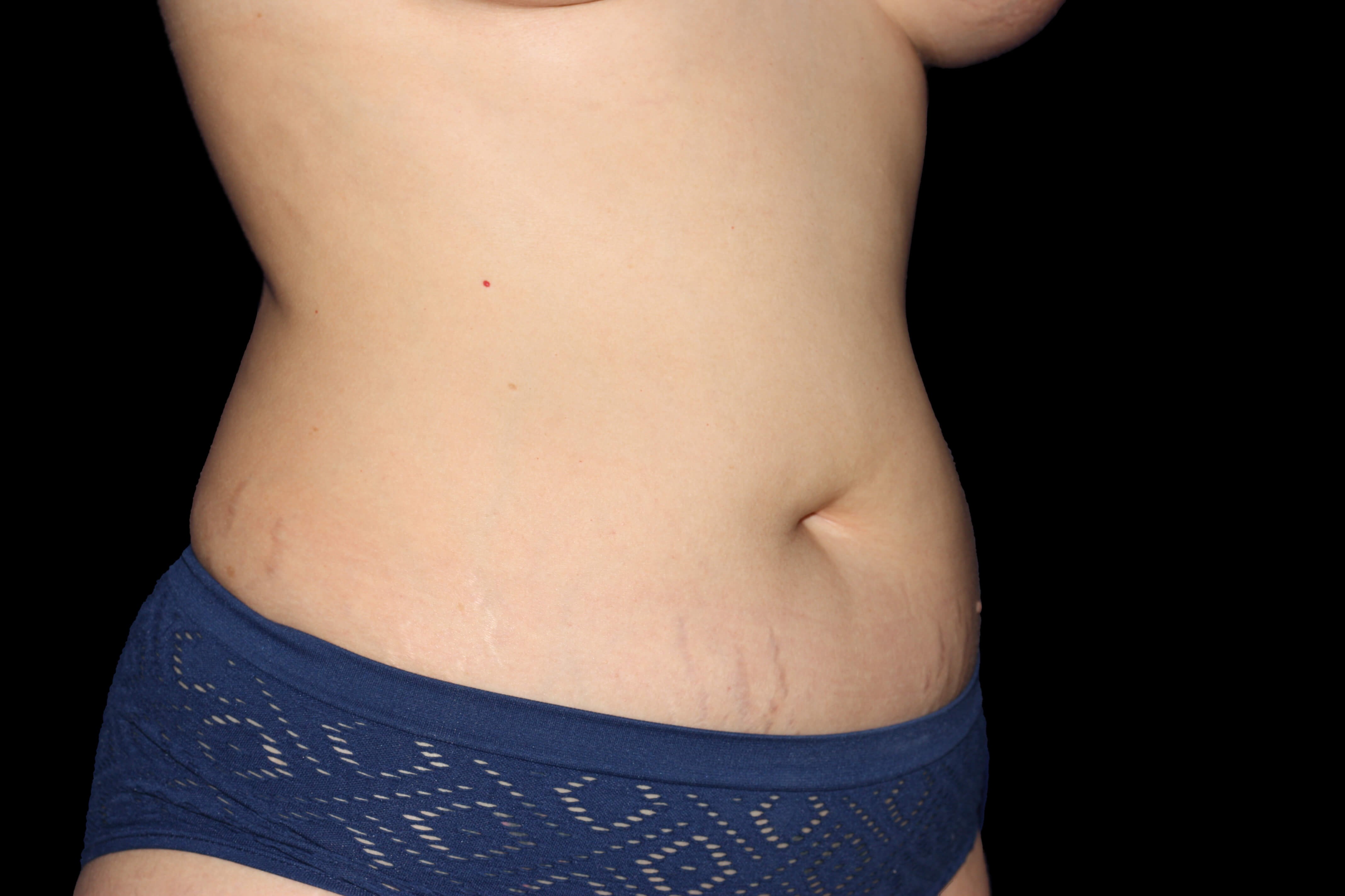Right oblique Before