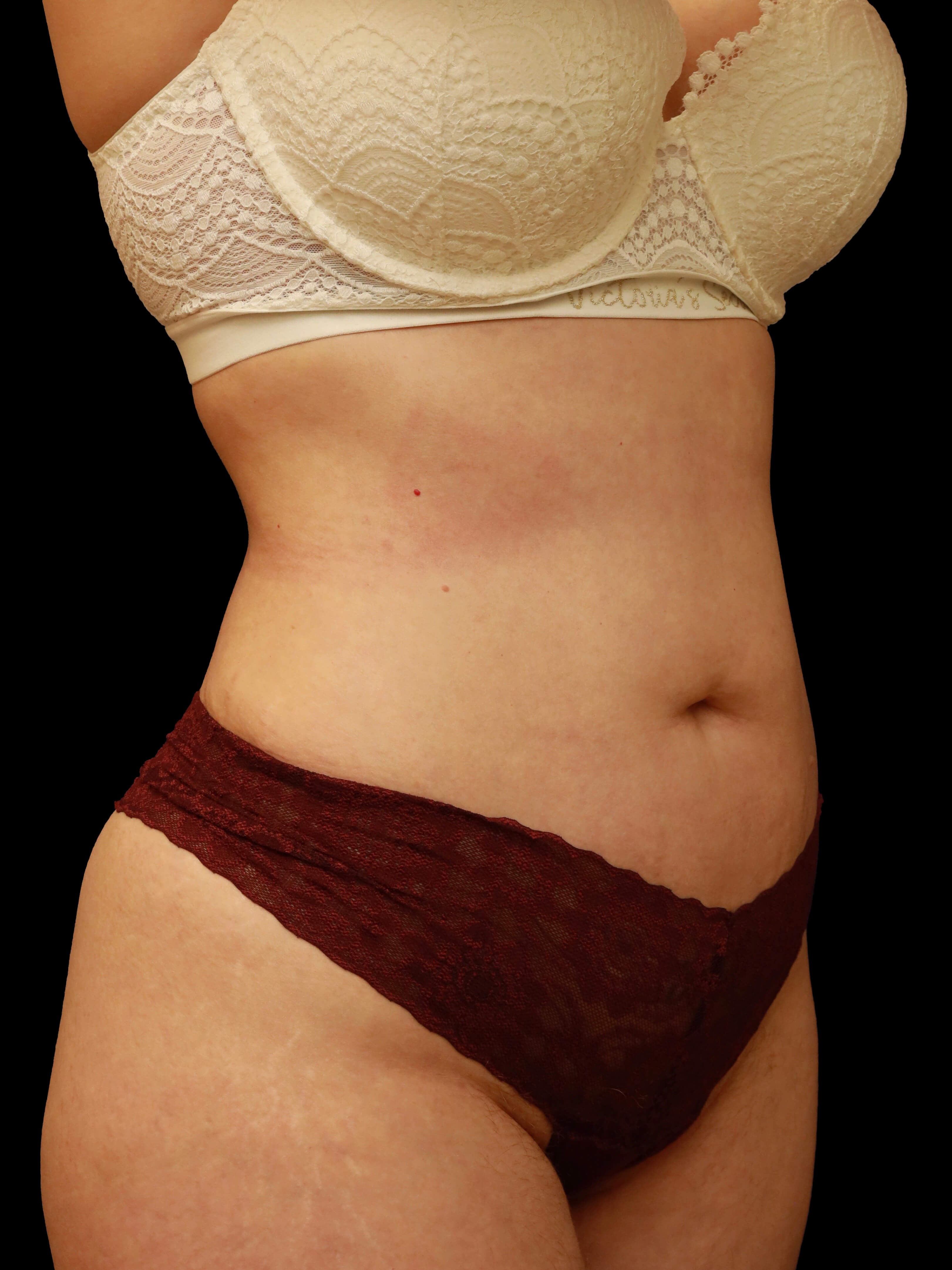 Right oblique After