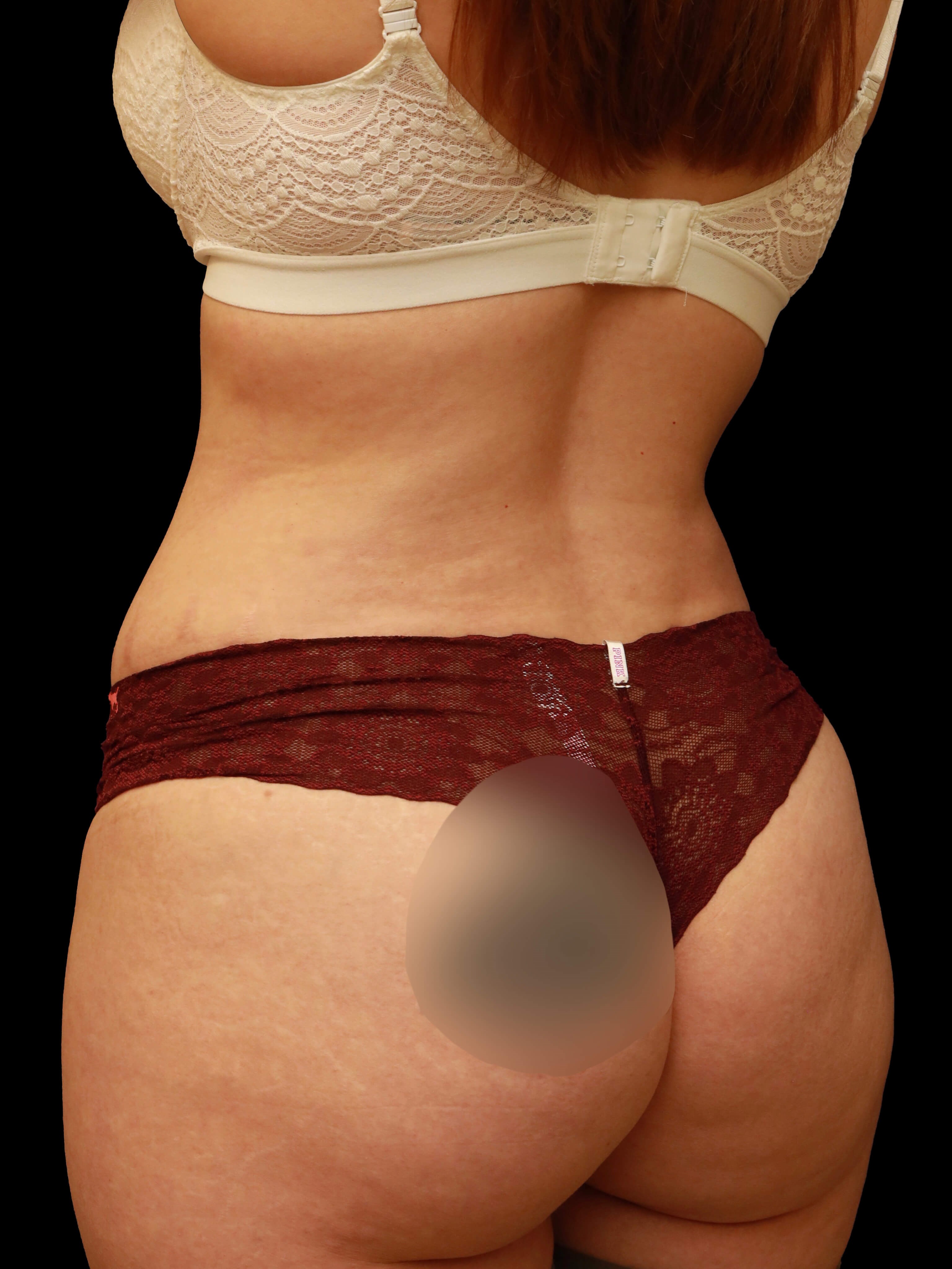 Left back oblique After