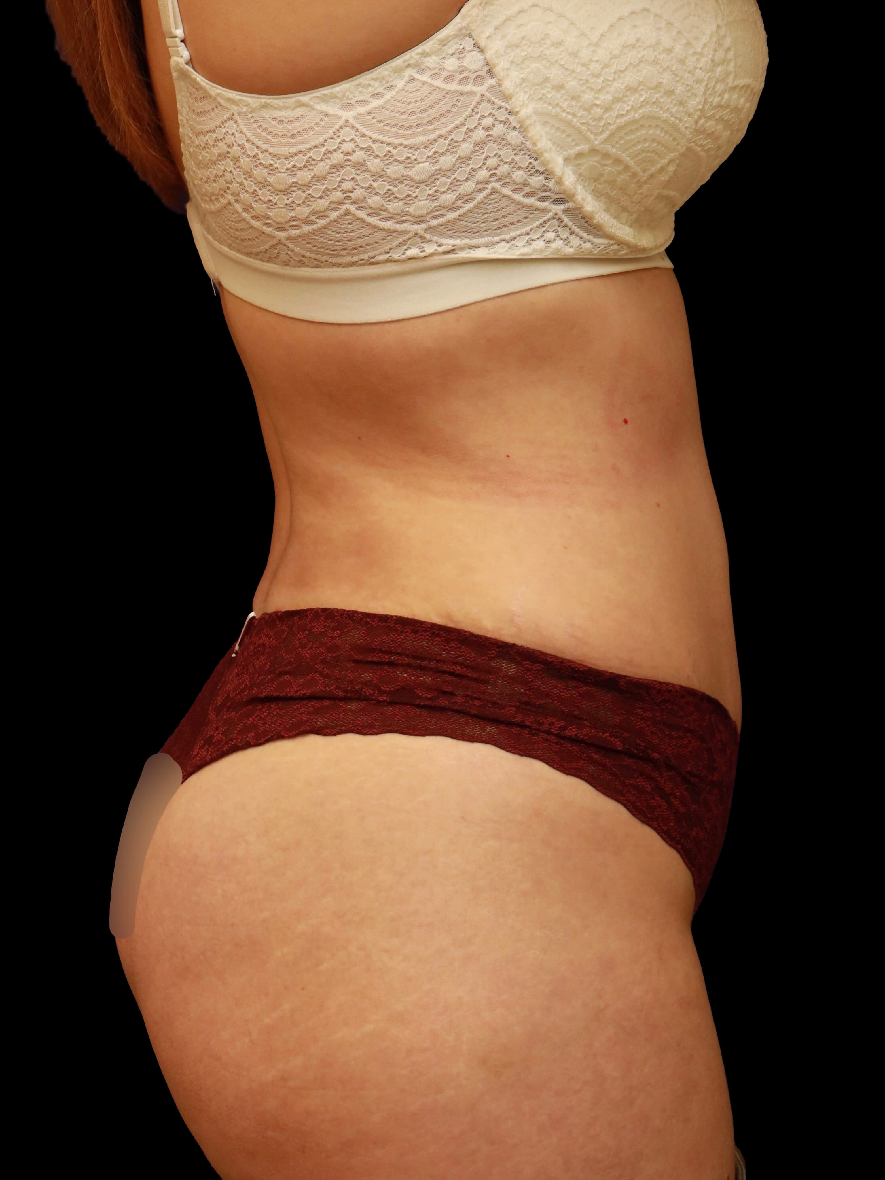 Right lateral After