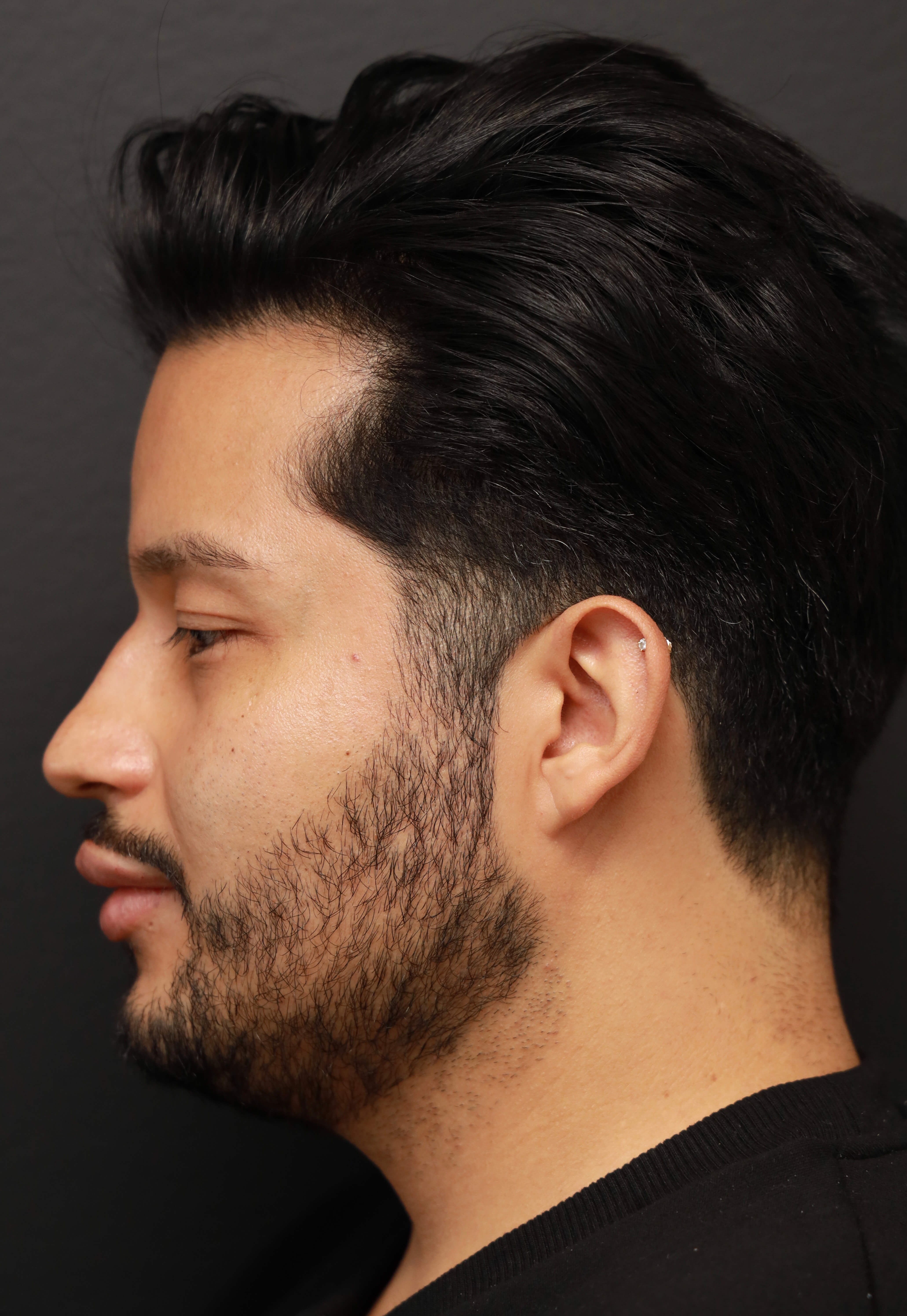 Left Lateral After