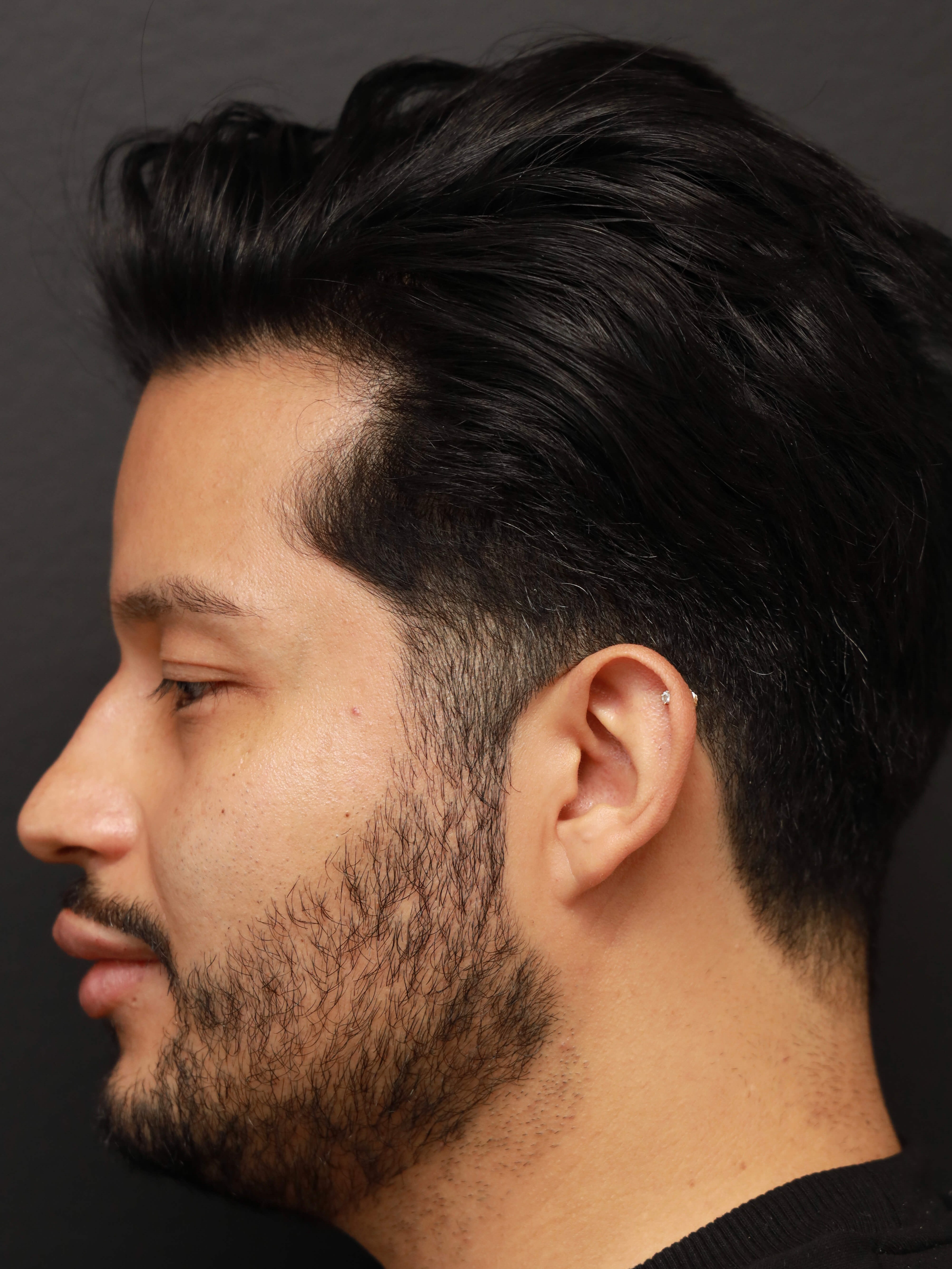 Left Lateral After