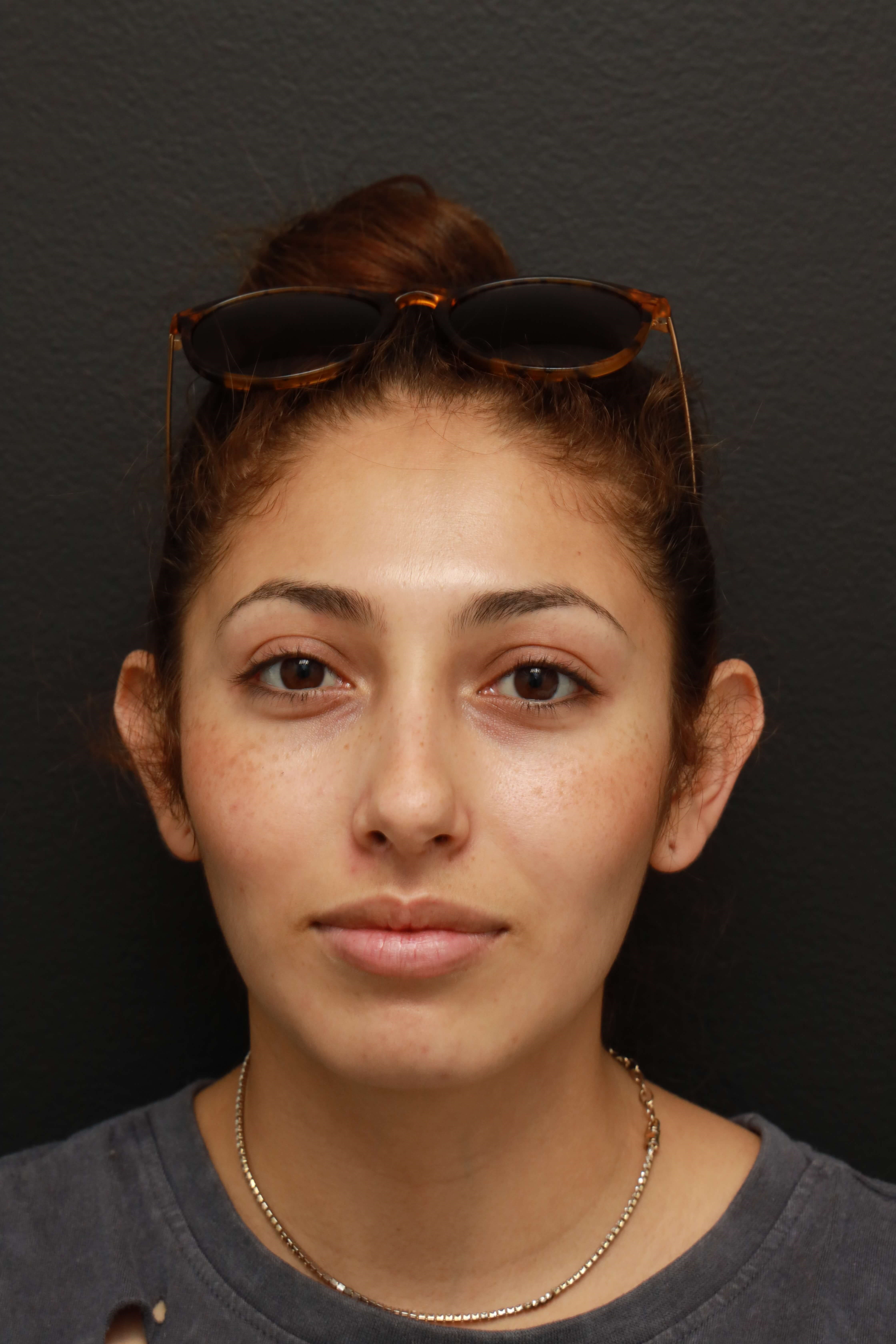AP Normal Before