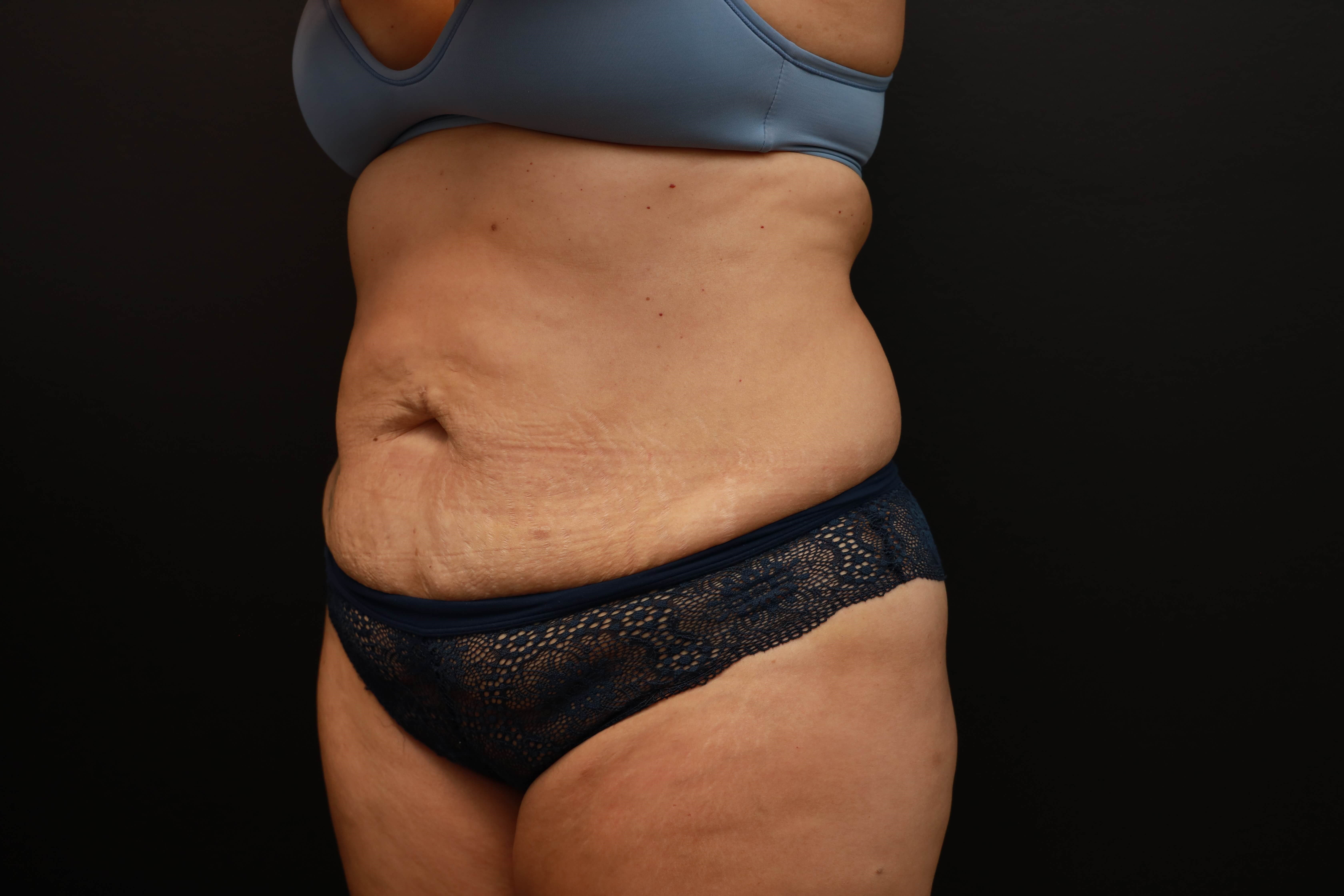 Left Oblique Before
