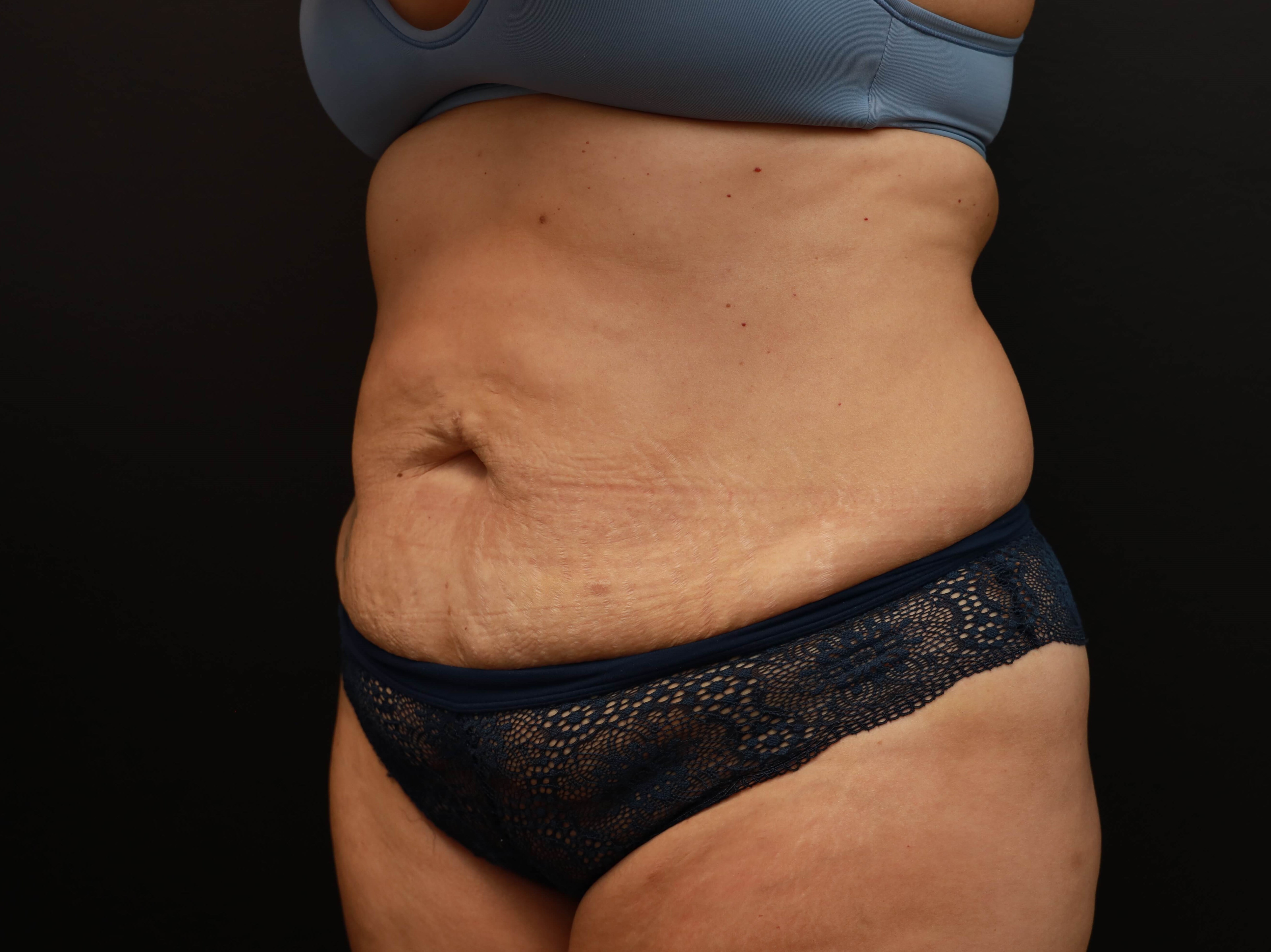 Left Oblique Before
