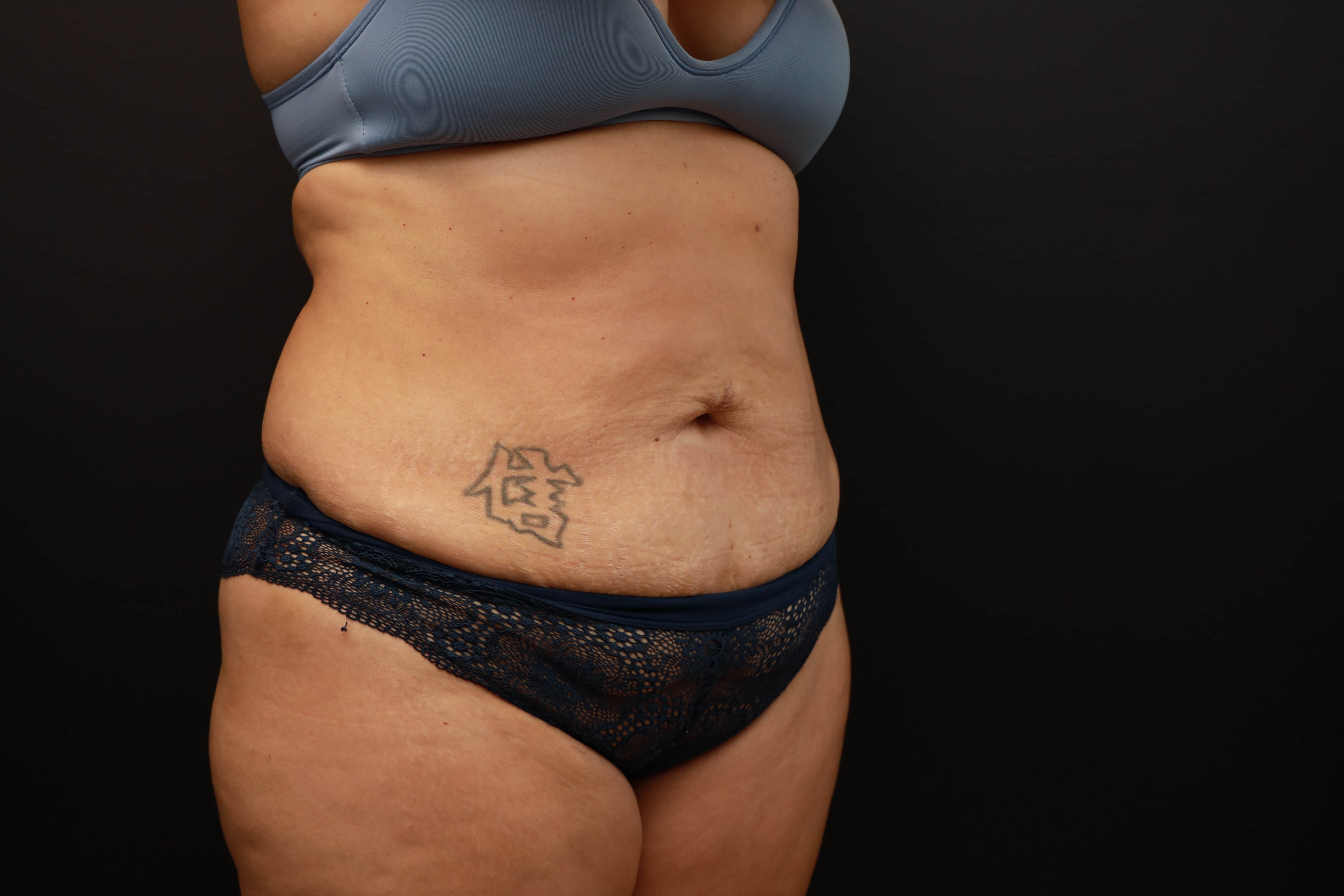 Right Oblique Before