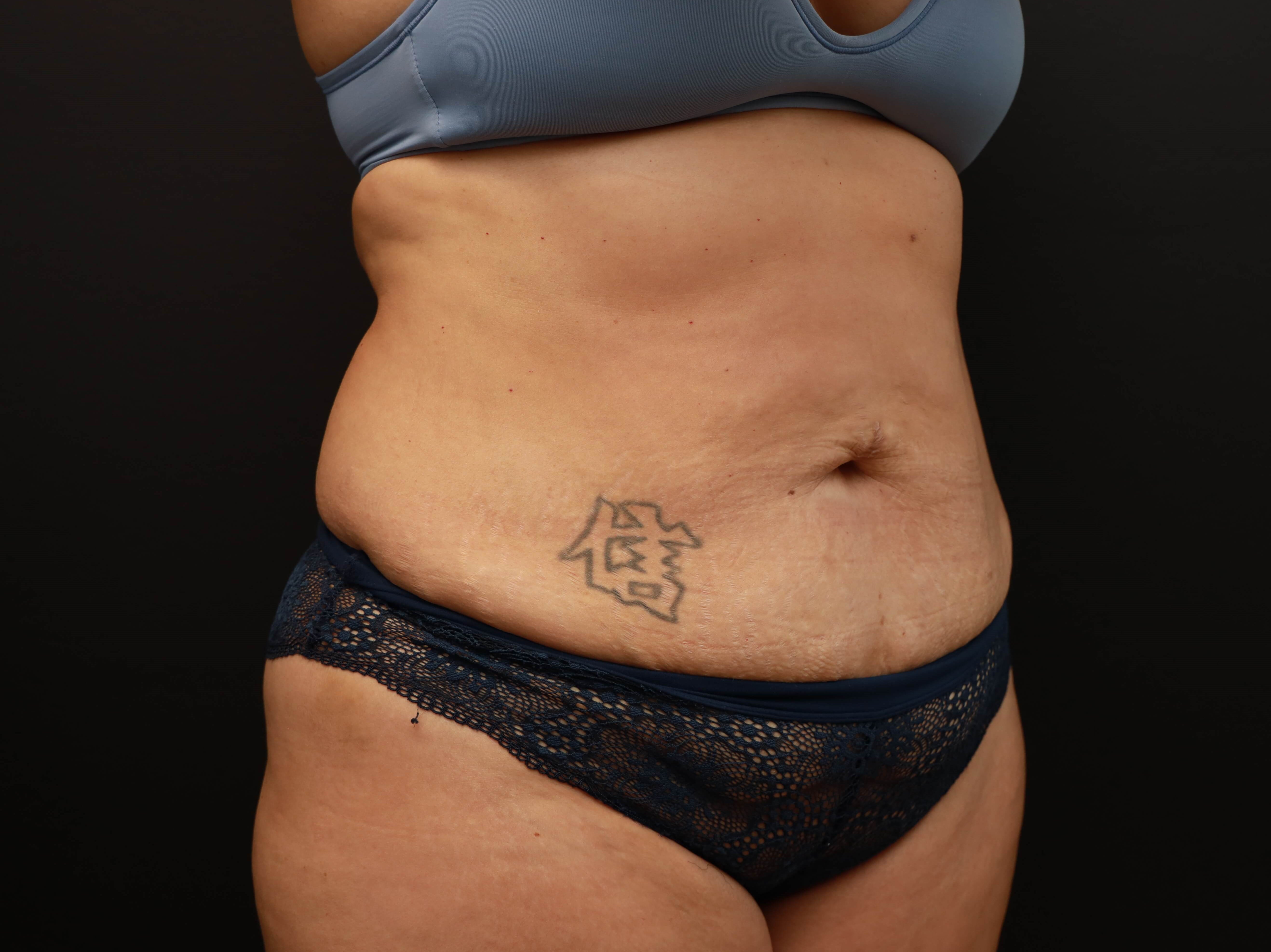 Right Oblique Before
