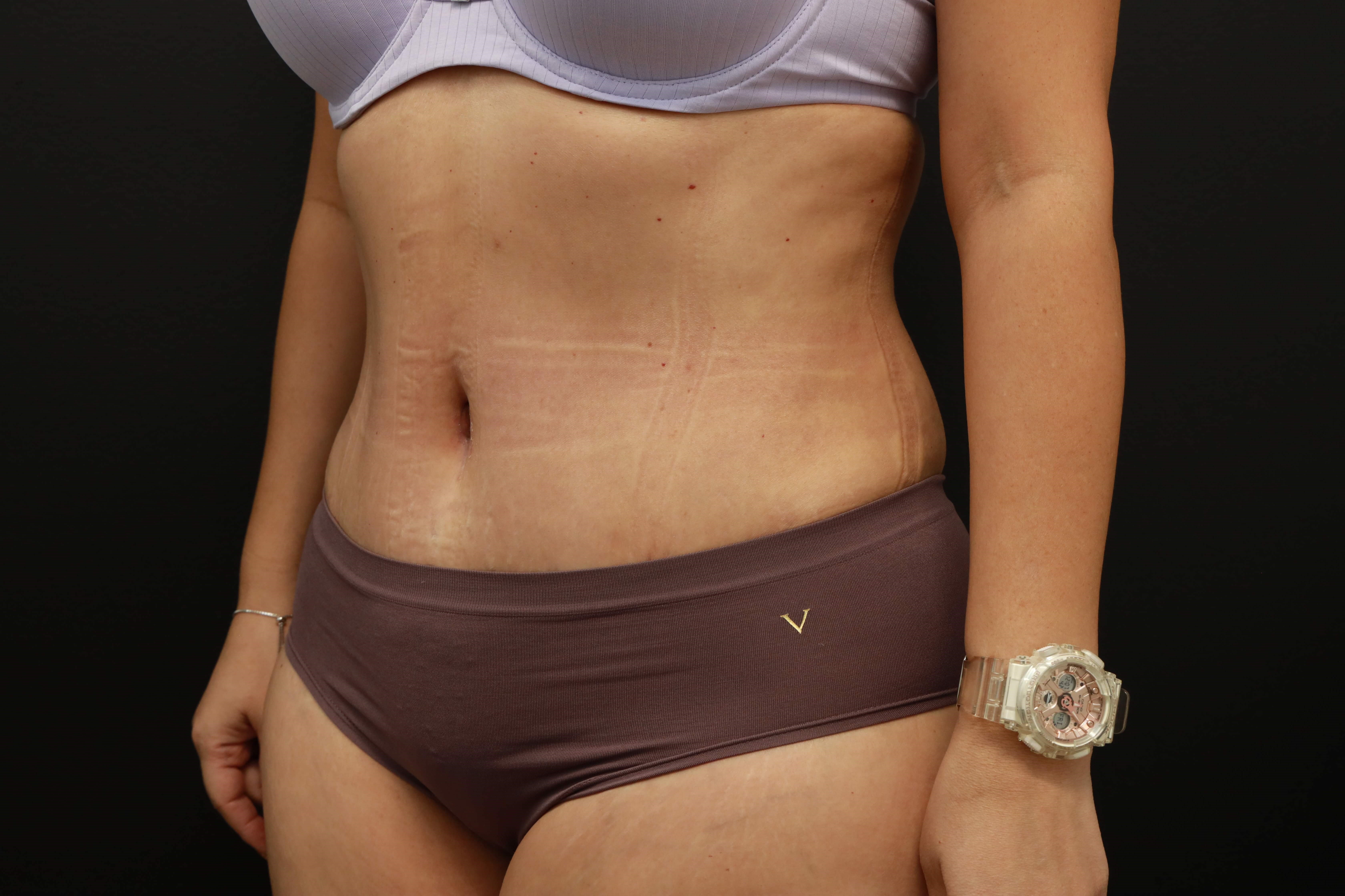 Left Oblique After
