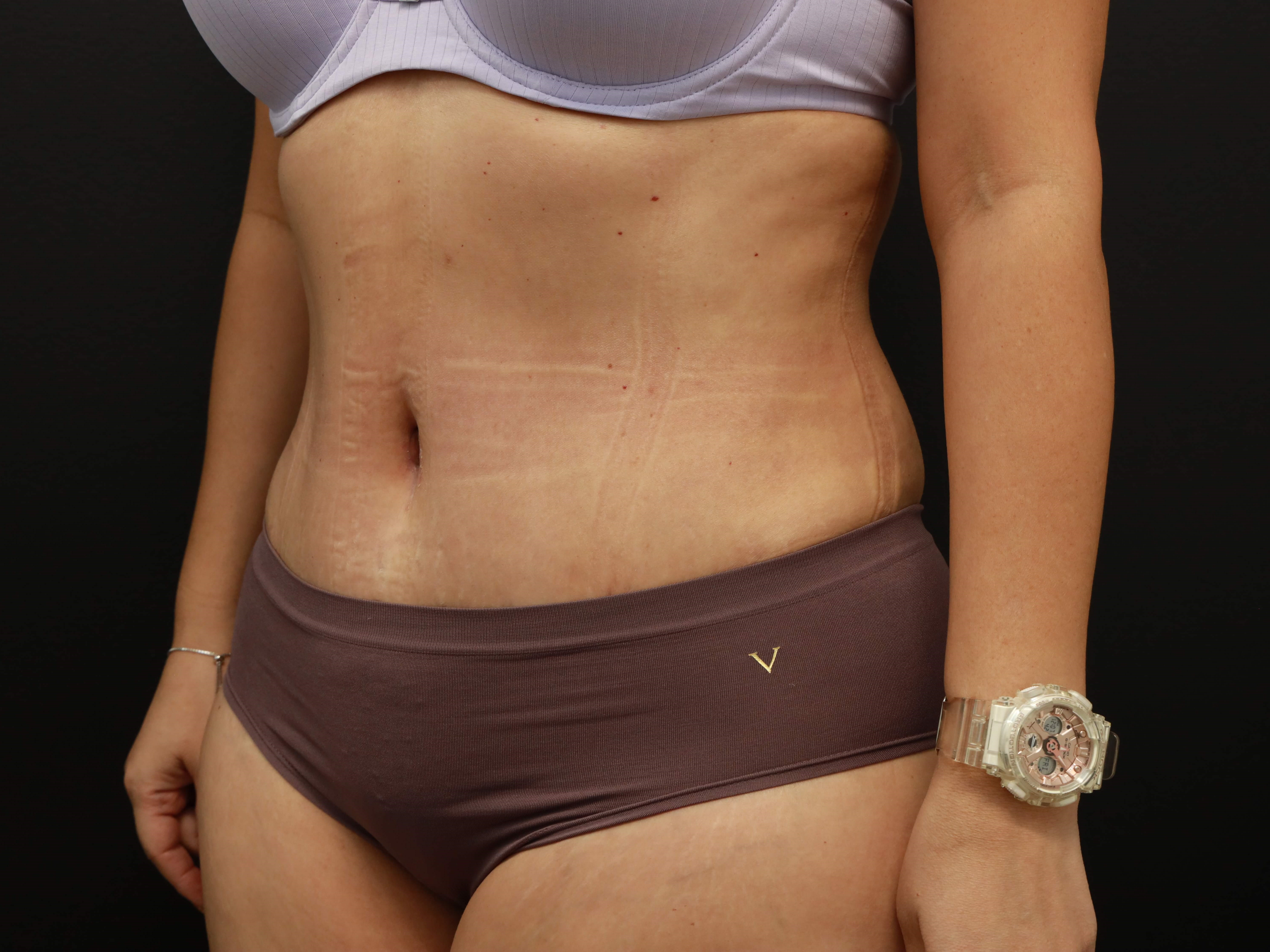 Left Oblique After