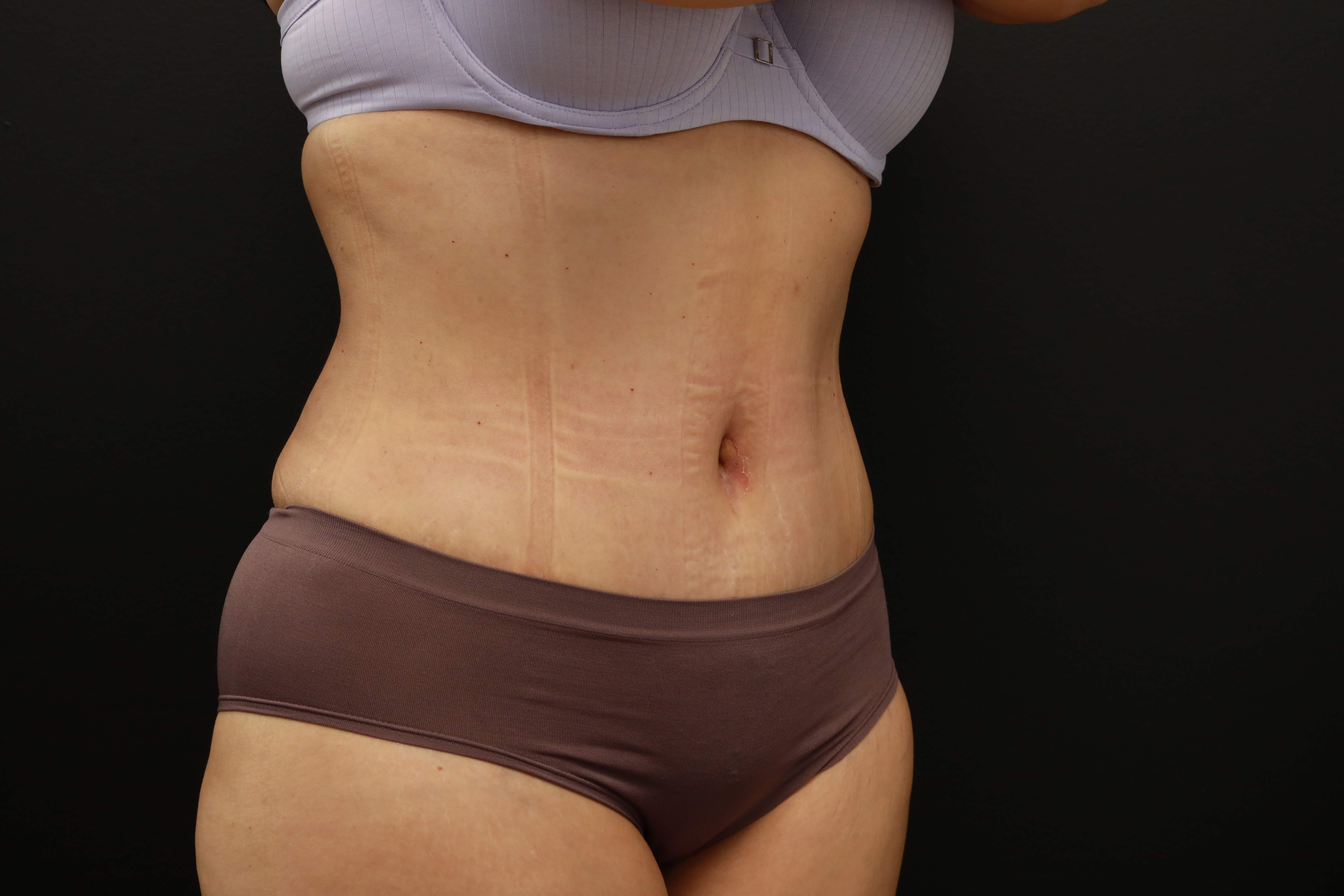Right Oblique After