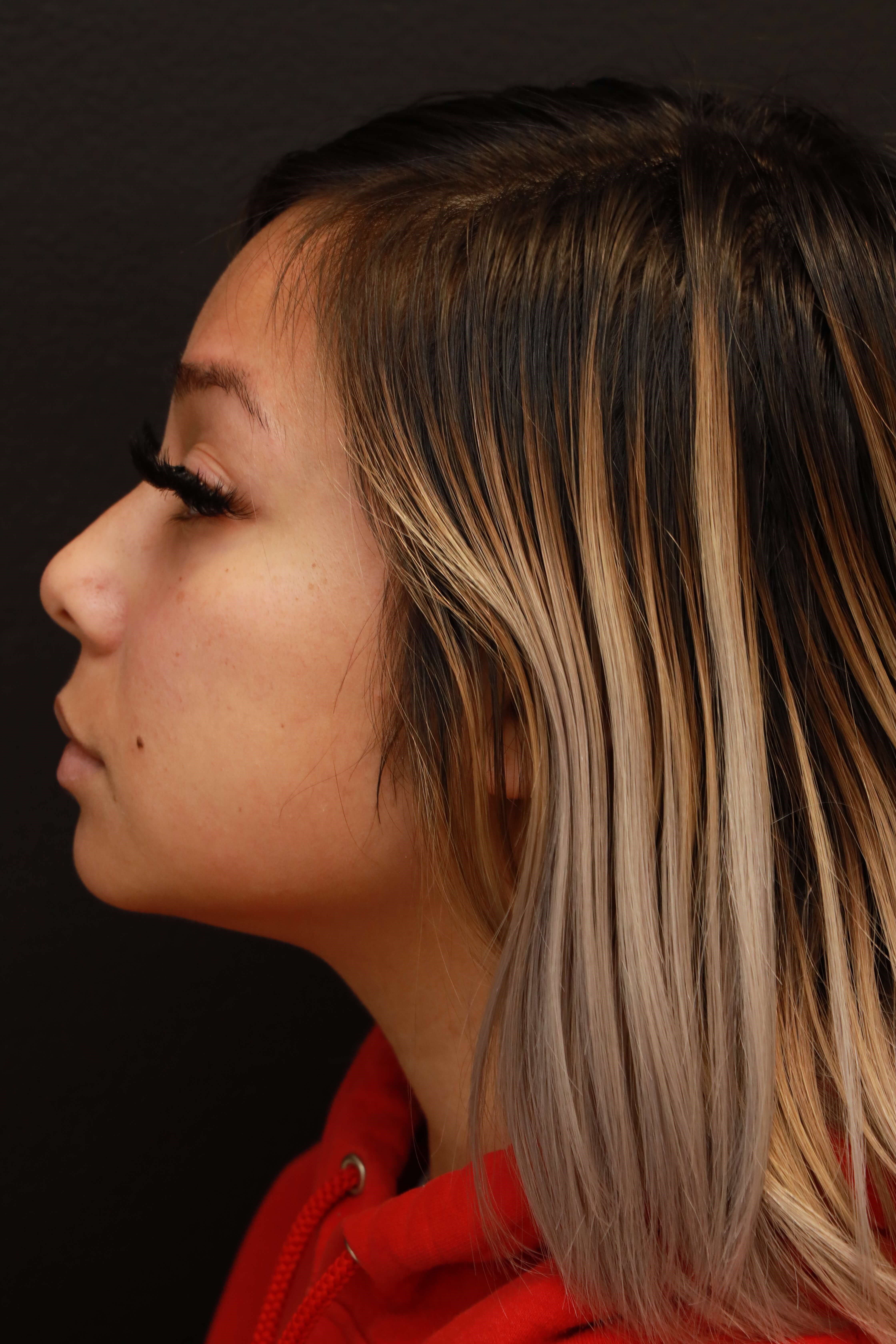 Left Lateral Before