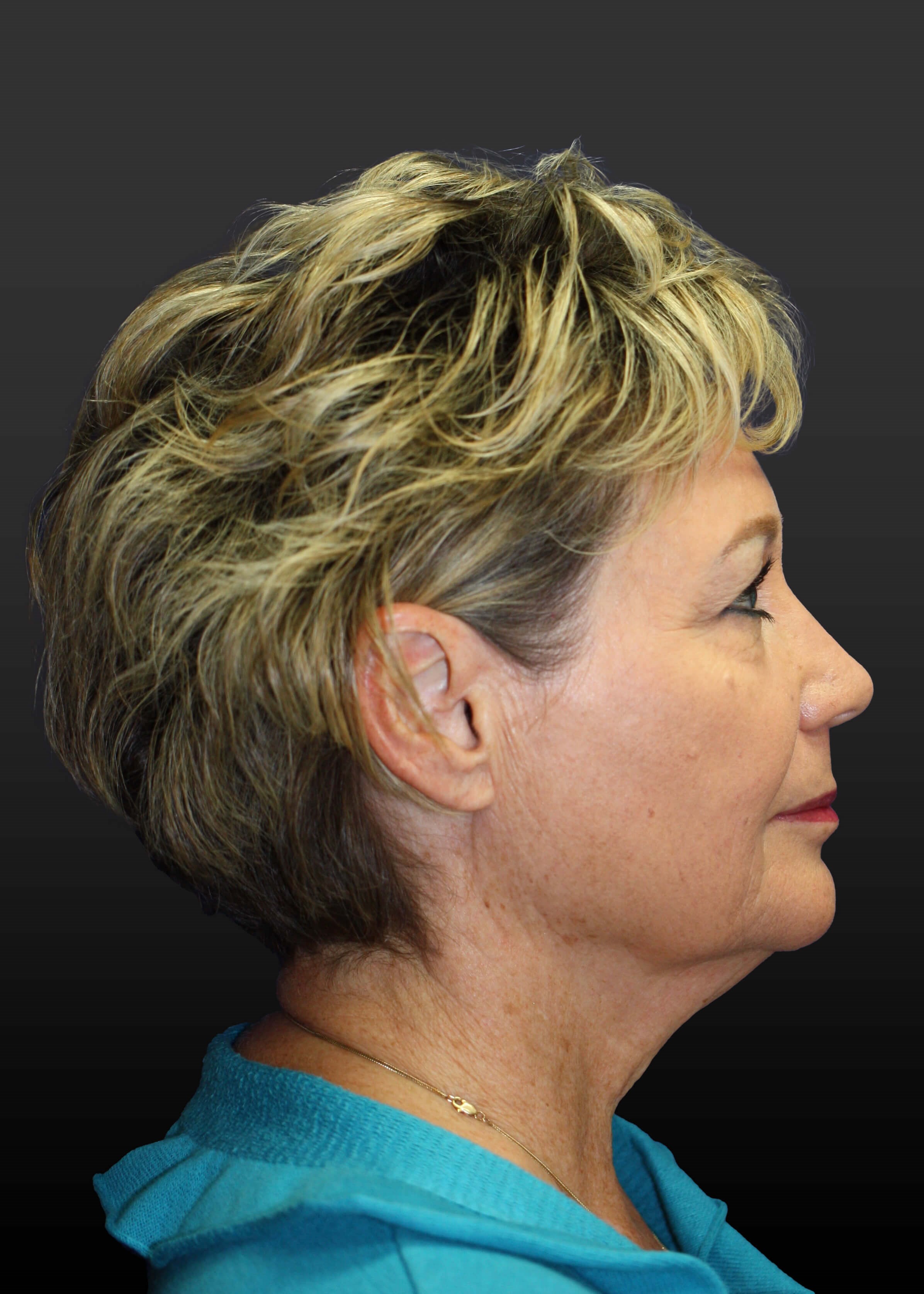 Right Lateral Before