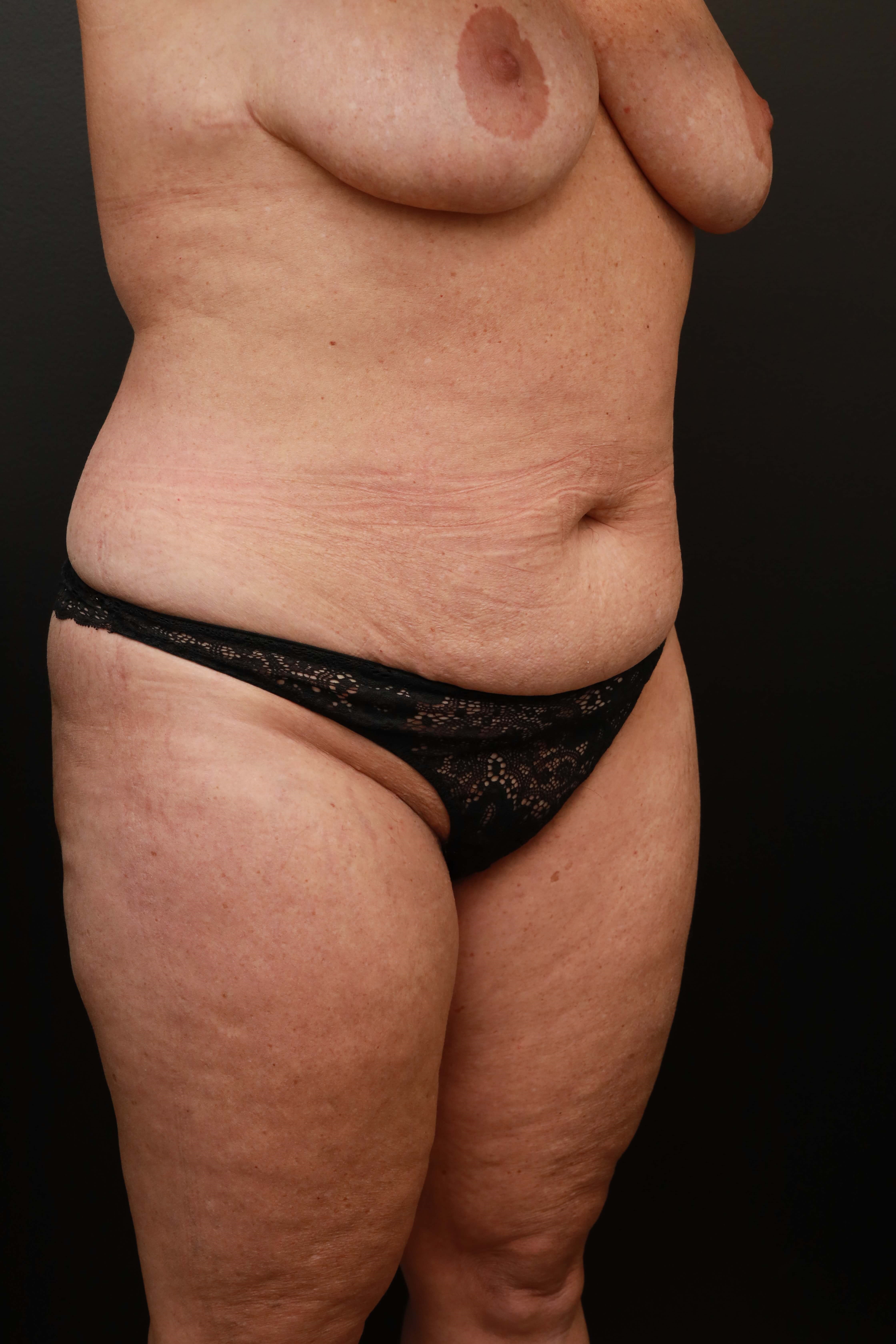 Right Oblique Before