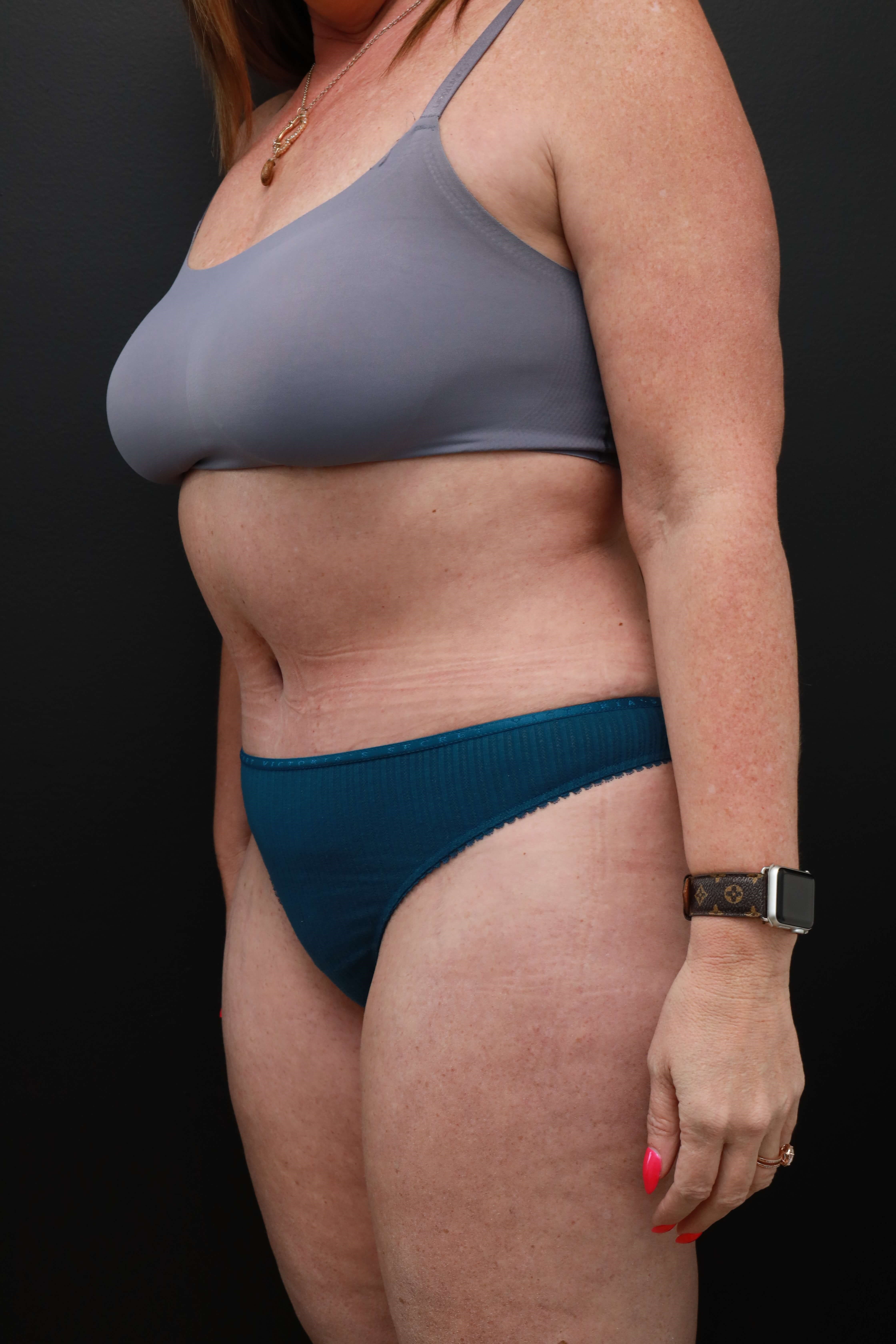 Left Oblique After