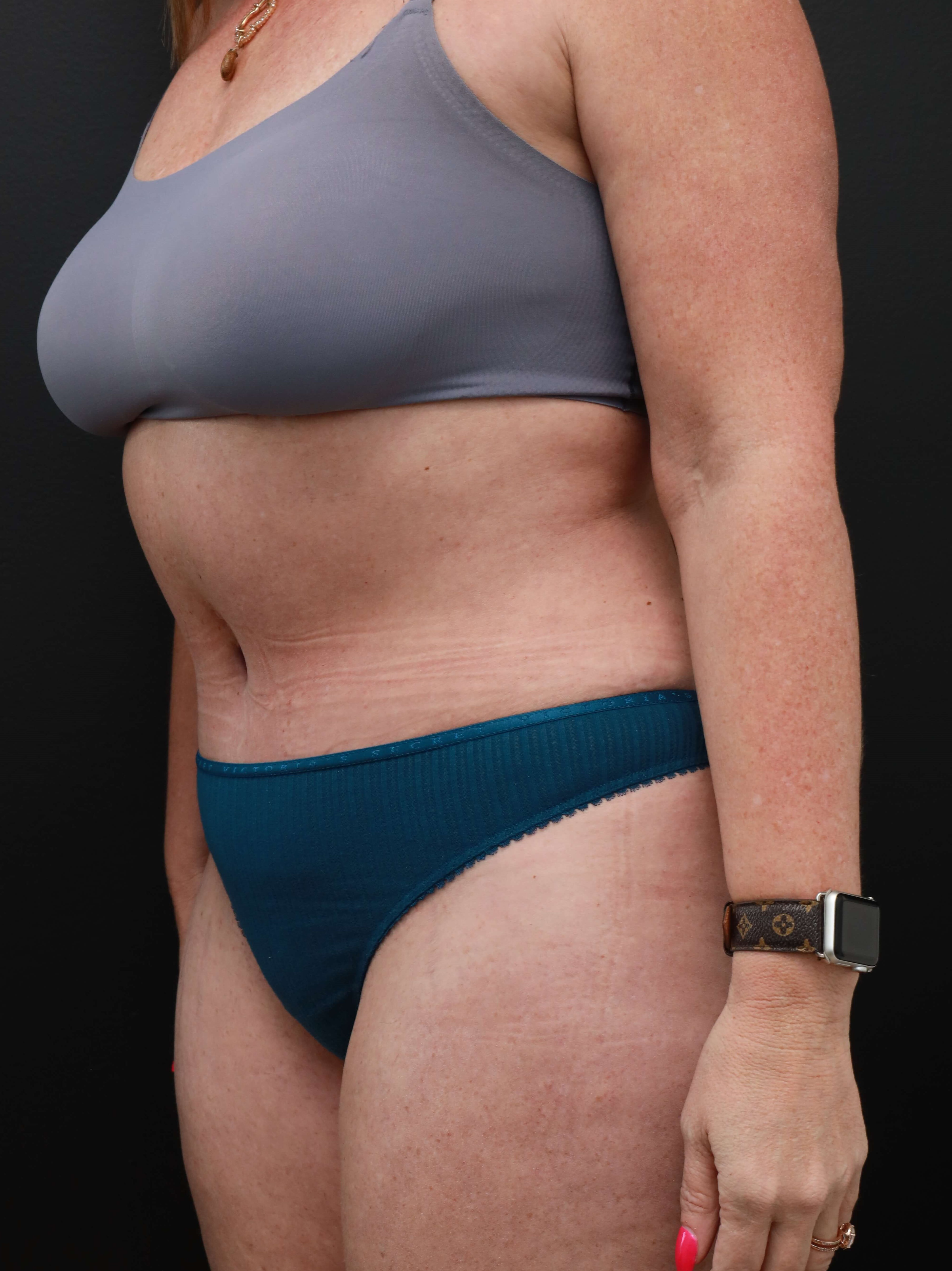 Left Oblique After